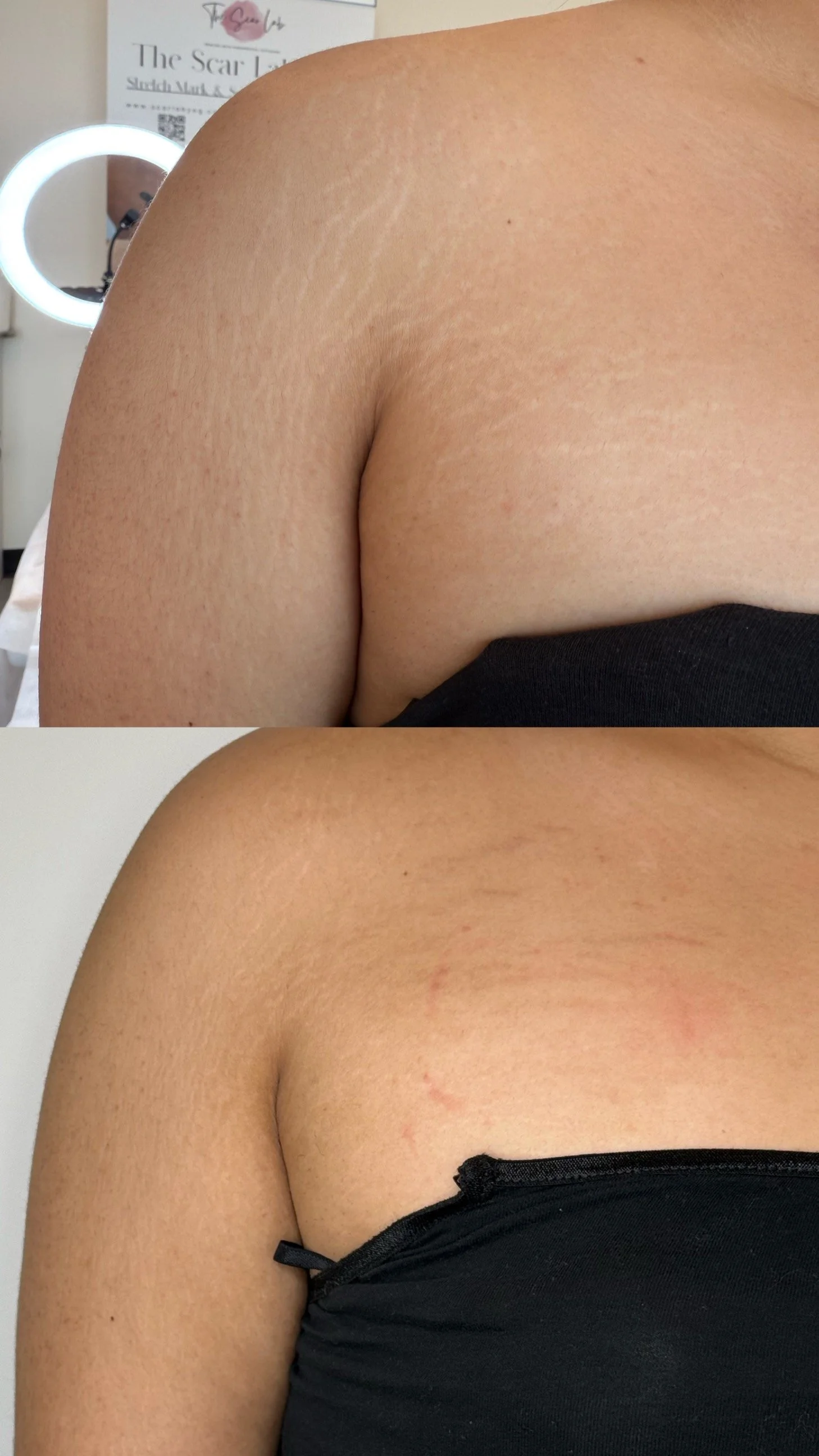 Before and after shoulder stretch marks following inkless stretch mark revision, showing improved skin texture and reduced stretch mark visibility.