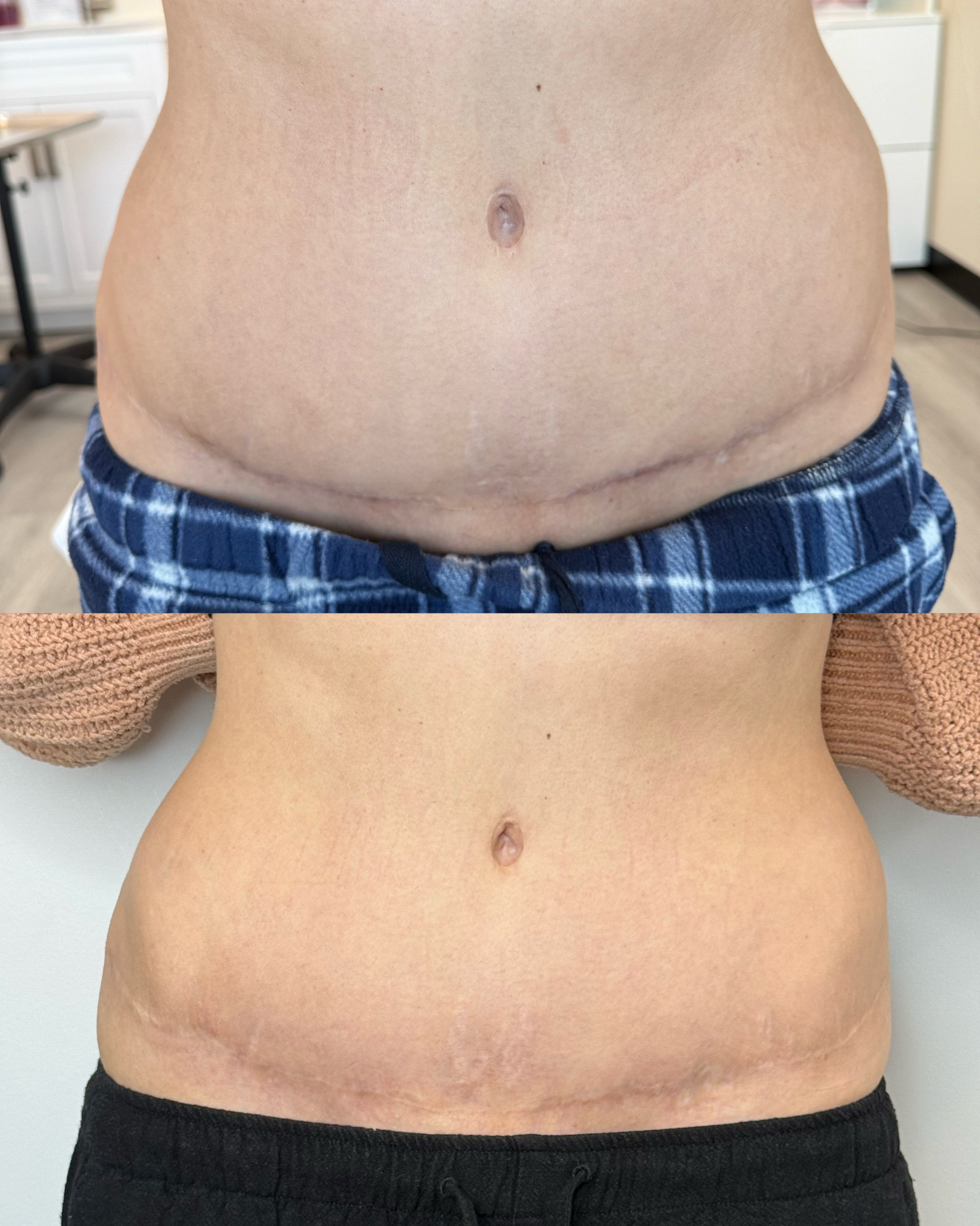 Scar camouflage and scar revision of a tummy tuck.