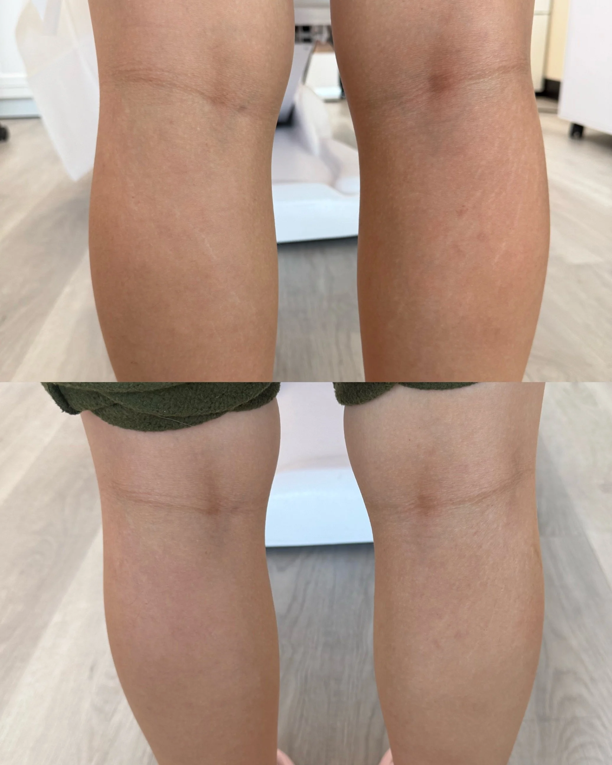 Before and after calves stretch marks following inkless stretch mark revision, showing improved skin texture and reduced visibility.