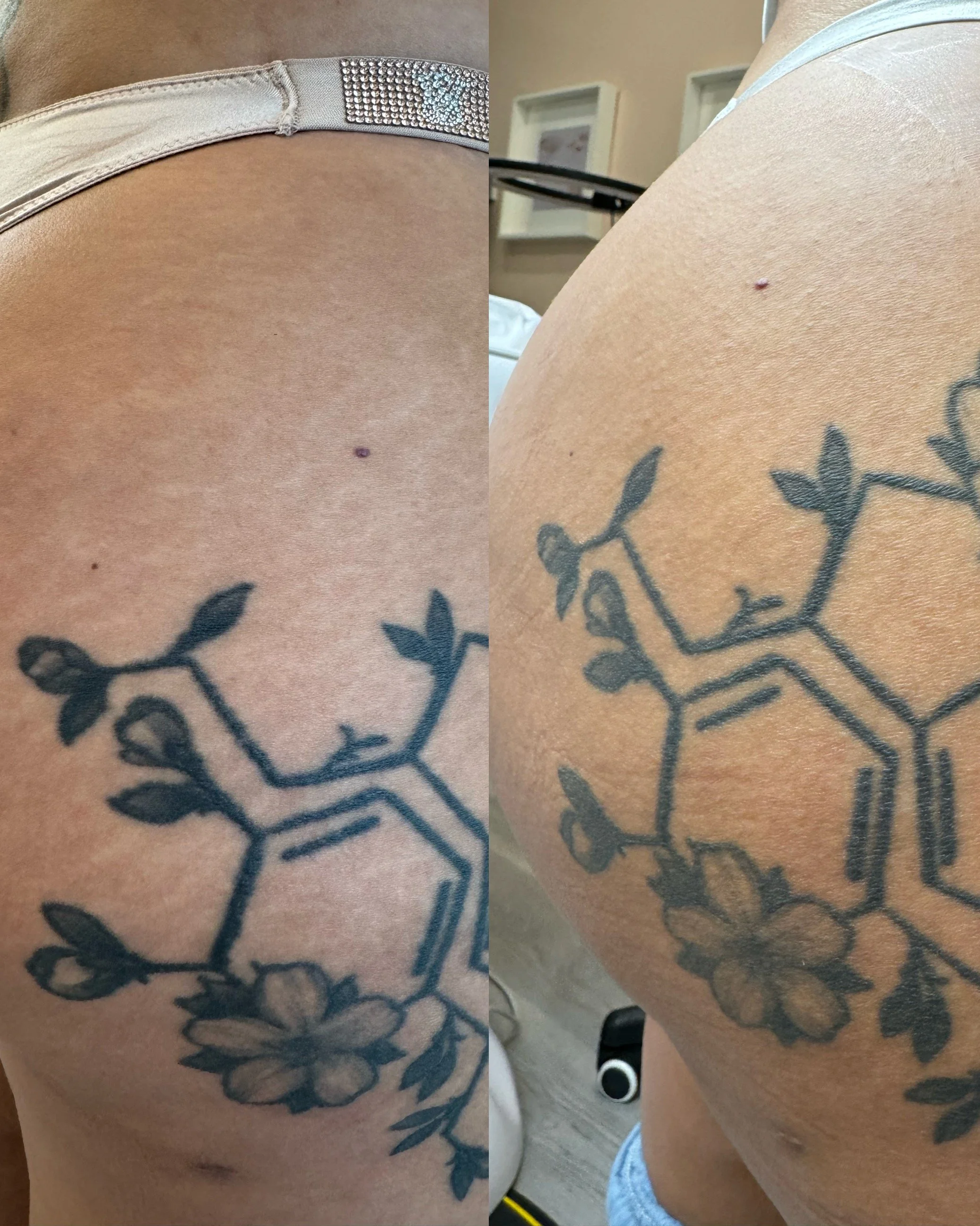 Before and after glute stretch marks following inkless stretch mark revision, showing improved skin texture and reduced stretch mark visibility.