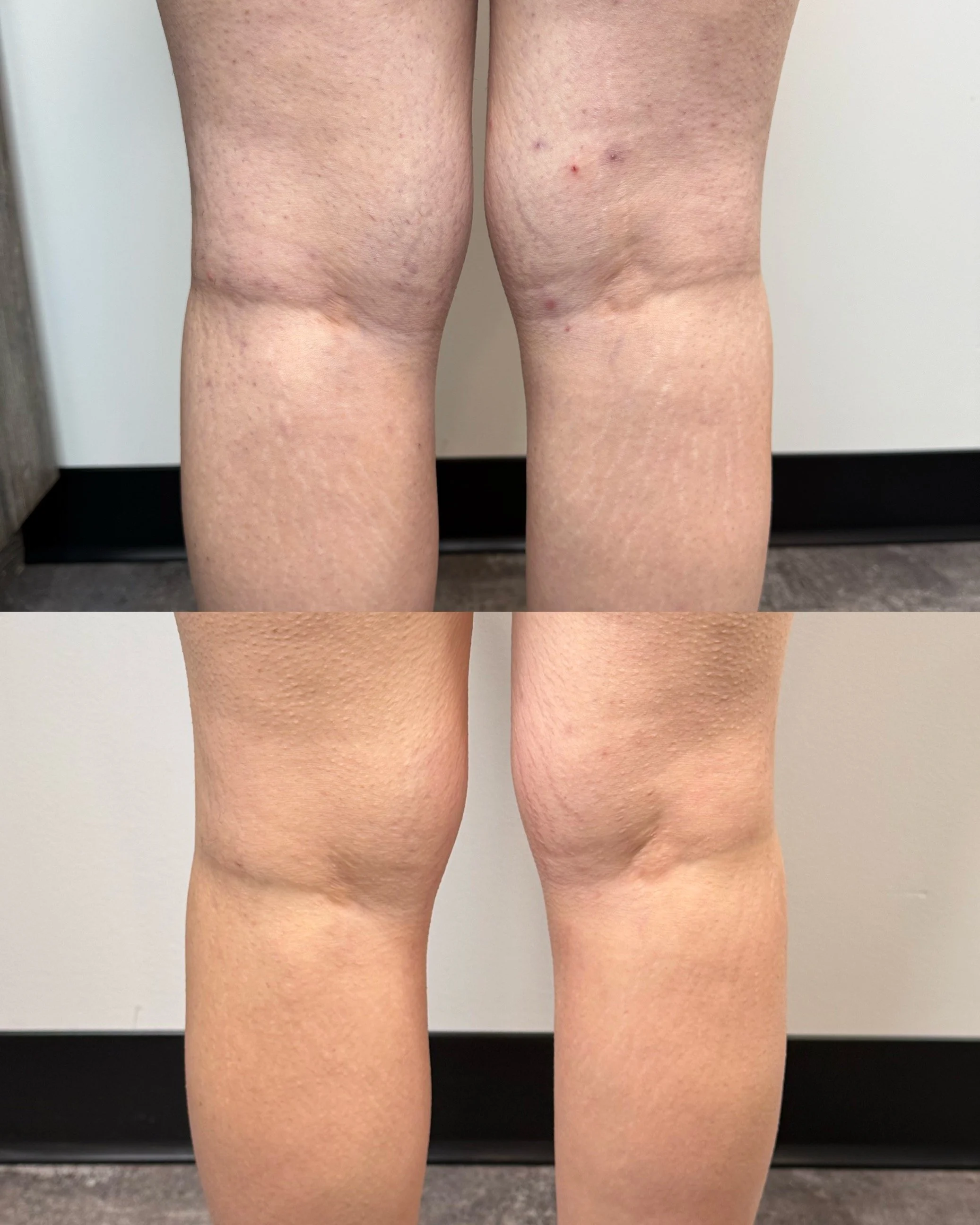Before and after calve and back of thigh stretch marks following inkless stretch mark revision, showing improved texture and reduced visibility.