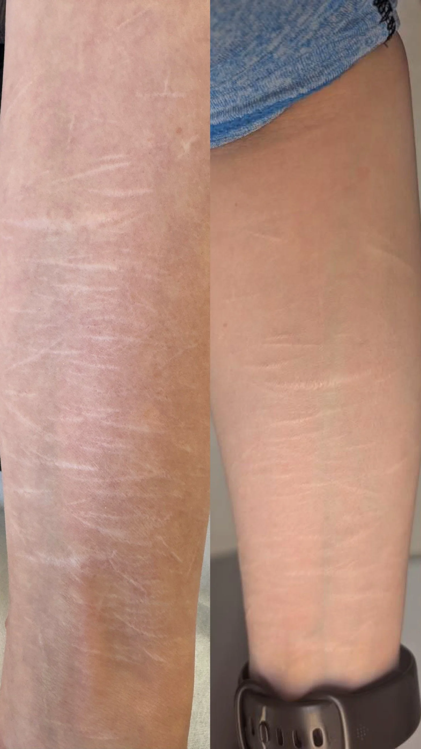 Before and after self harm scars following scar camouflage treatment, showing improved colour blending and reduced scar visibility.