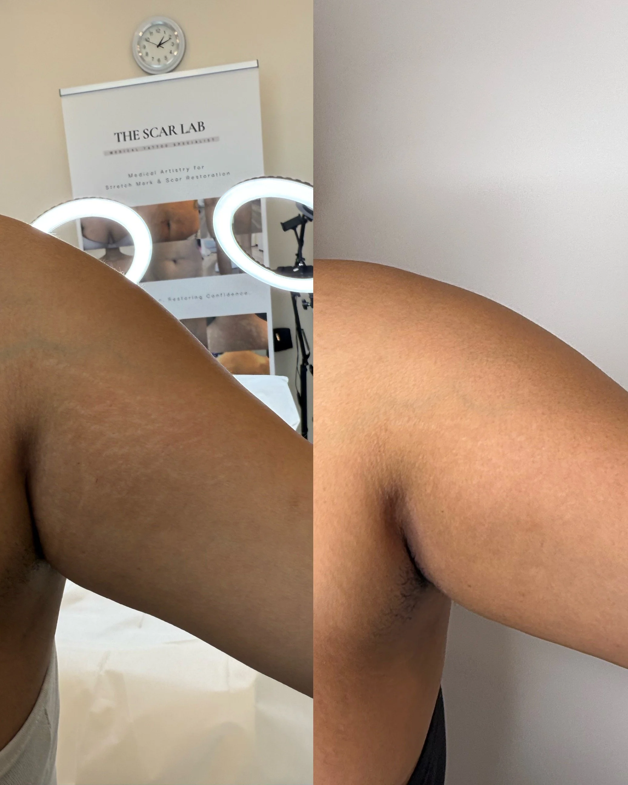 Before and after progress of inner arm stretch marks following inkless stretch mark revision, showing improved skin texture and reduced visibility.