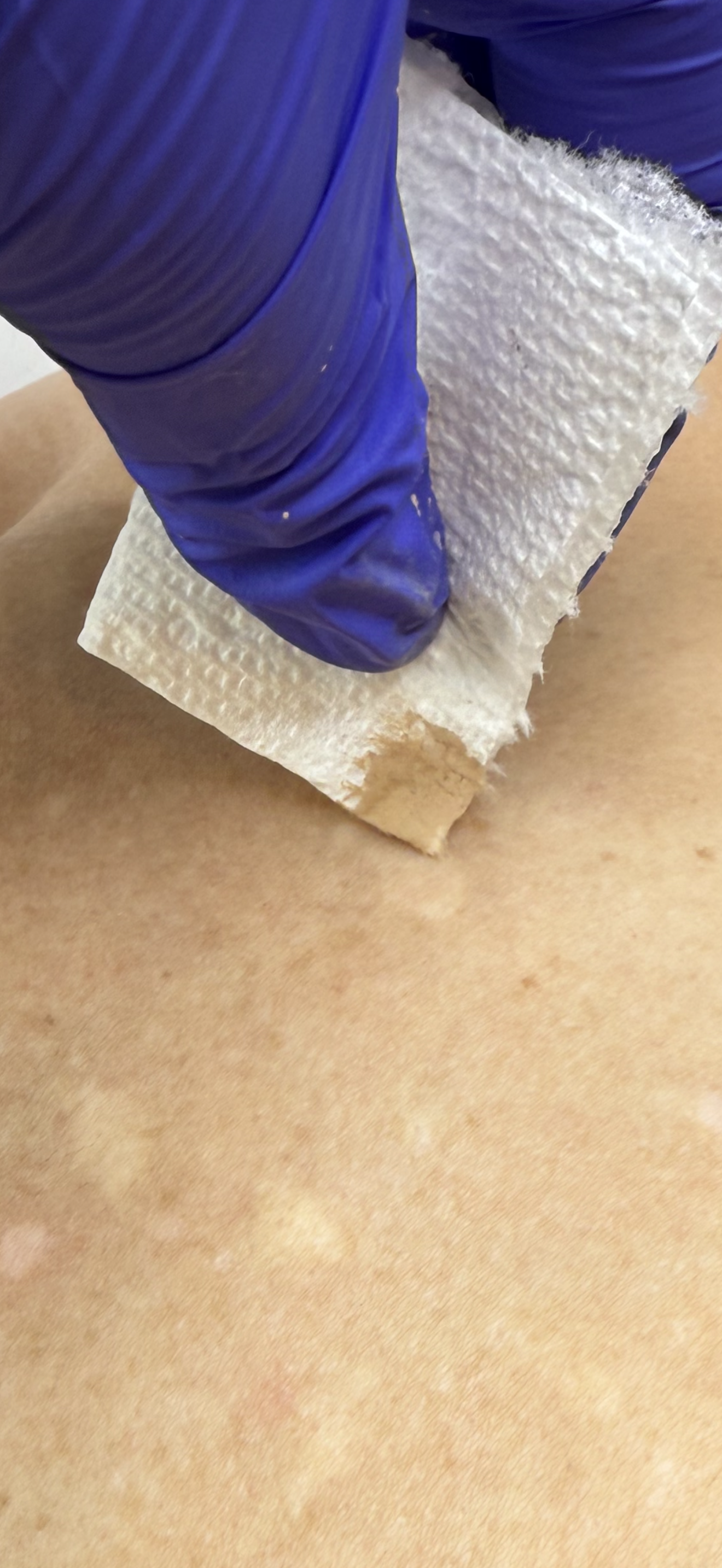 Custom skin tone colour match for hypopigmented scar camouflage treatment.