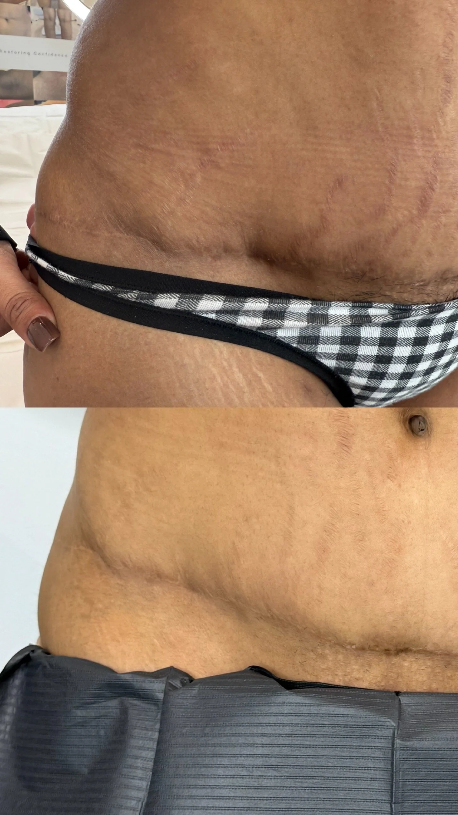 Scar solution for tummy tuck scar in Edmonton. Texture and hyperpigmentation improvement for cosmetic surgery.