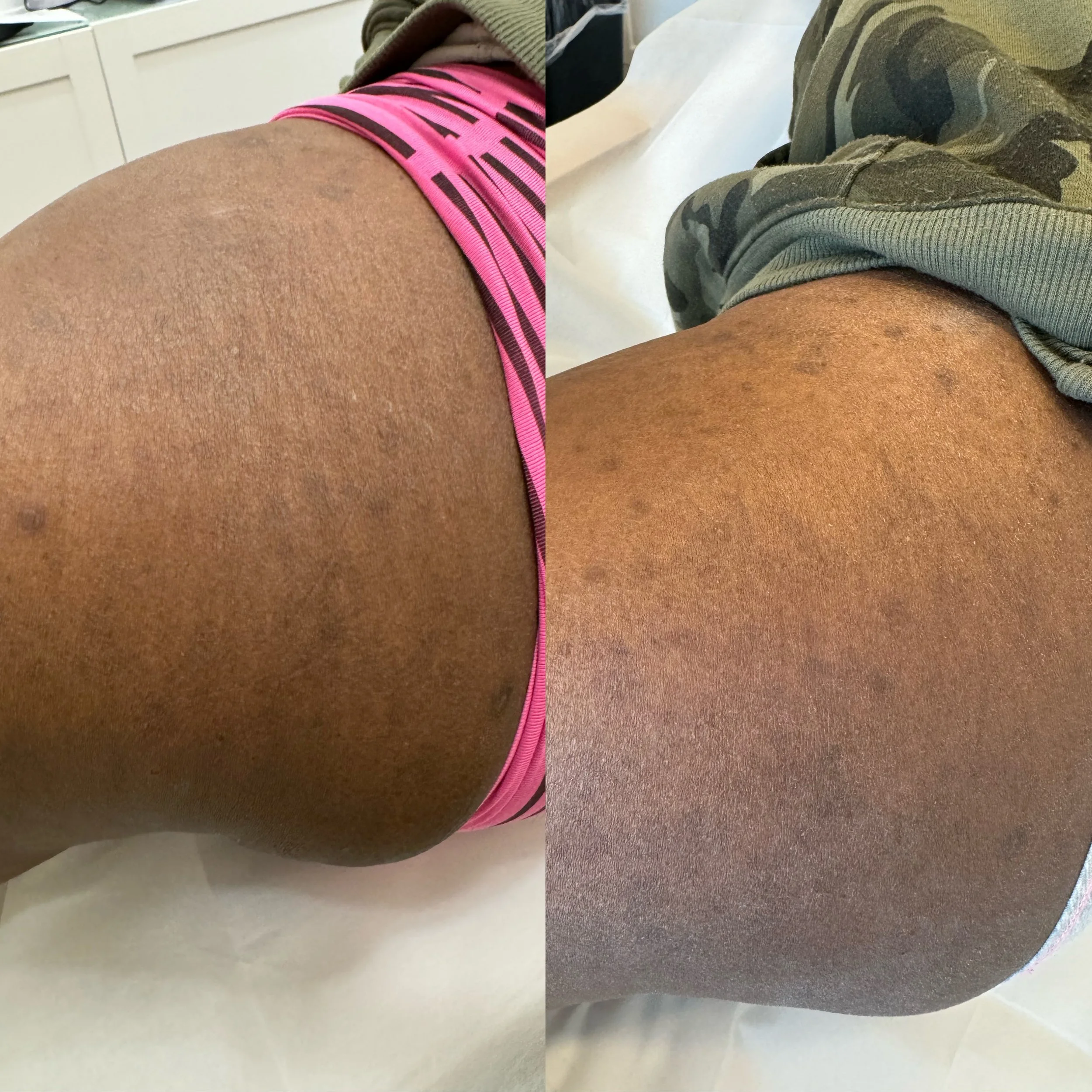 Before and after glute stretch marks following stretch mark camouflage treatment, showing improved colour blending and reduced stretch mark visibility.