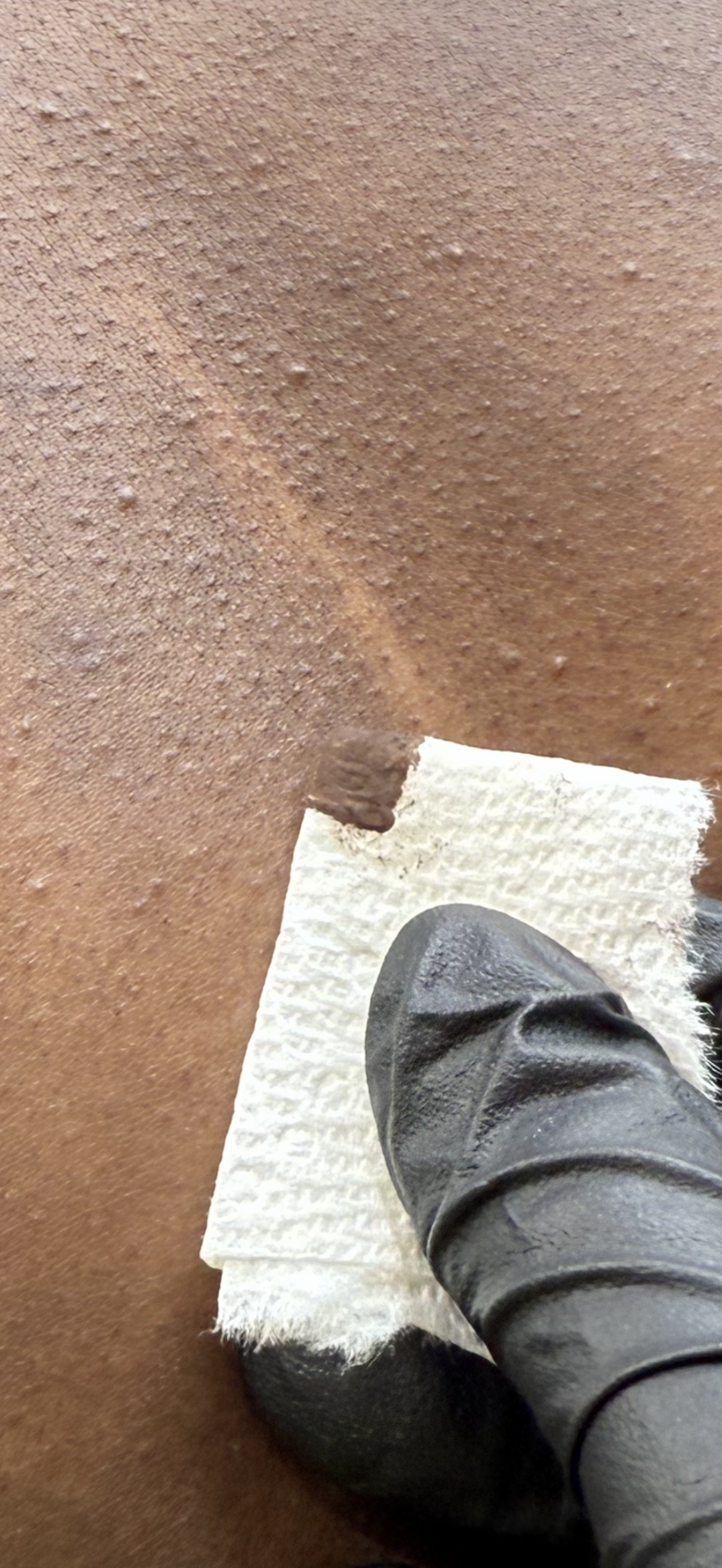 Custom skin tone colour match for chest scar camouflage on melanin rich skin.