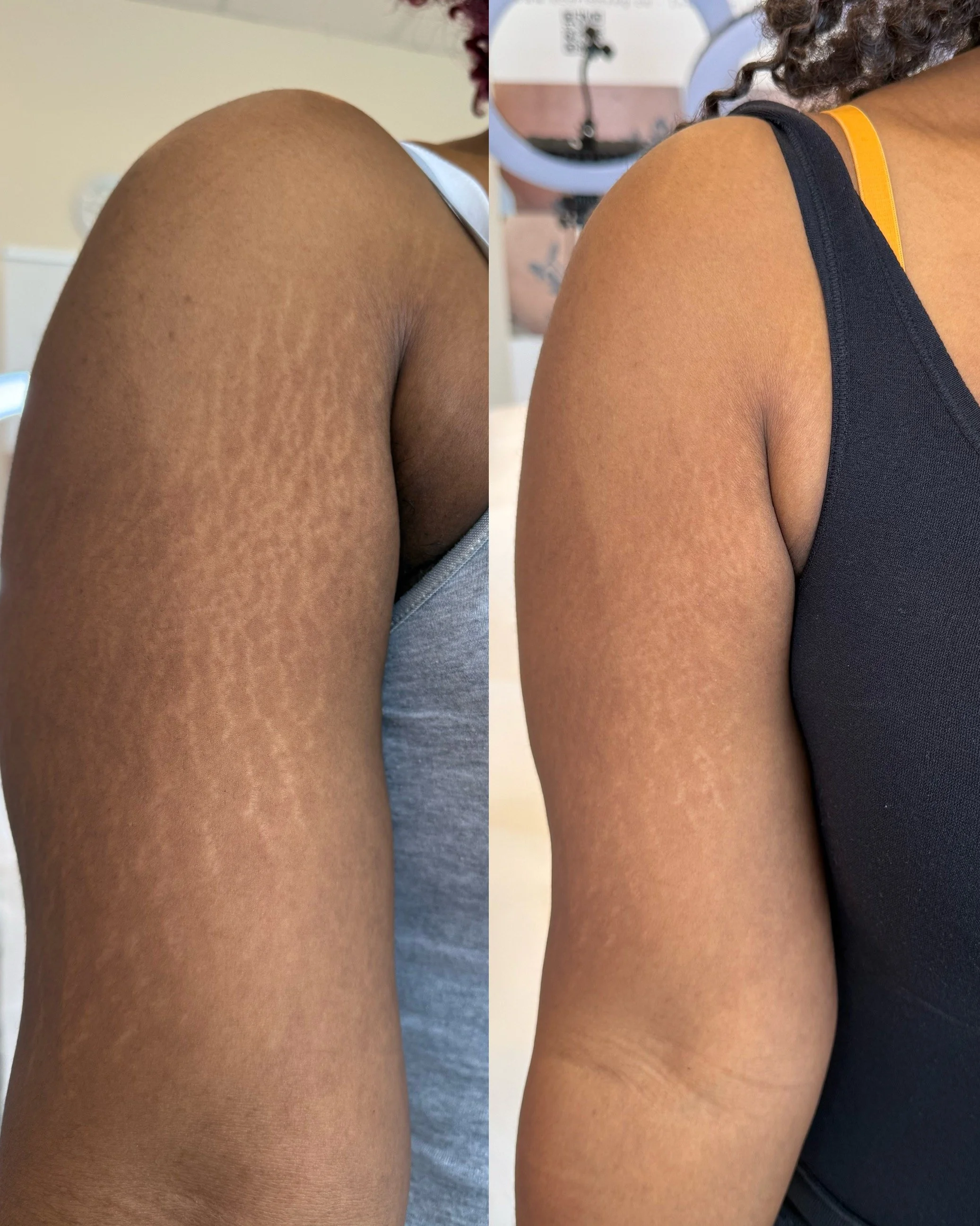 In progress arm stretch marks on melanin rich skin following inkless stretch mark revision, showing improved texture and reduced visibility.