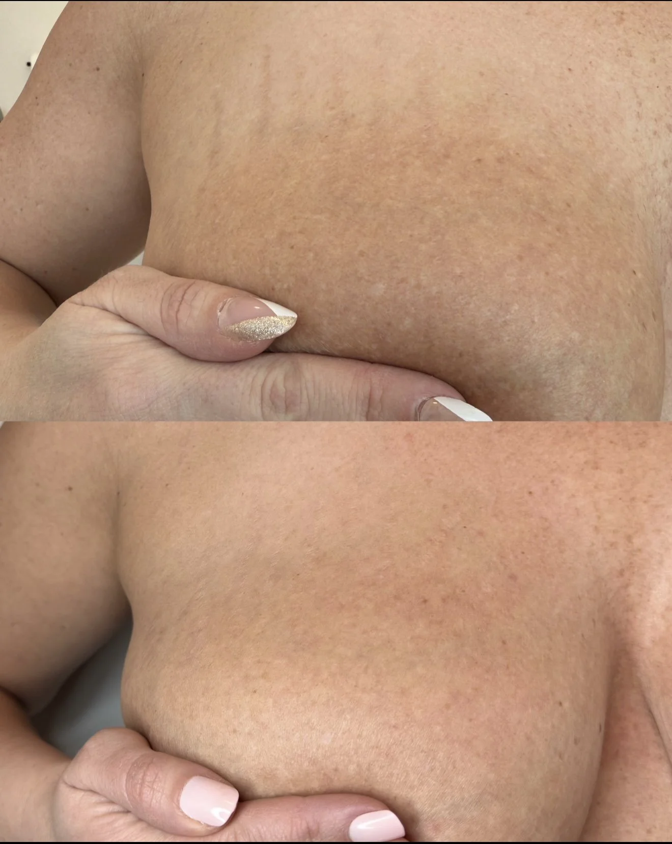Before and after breast stretch mark revision showing improved skin texture and reduced appearance of stretch marks.