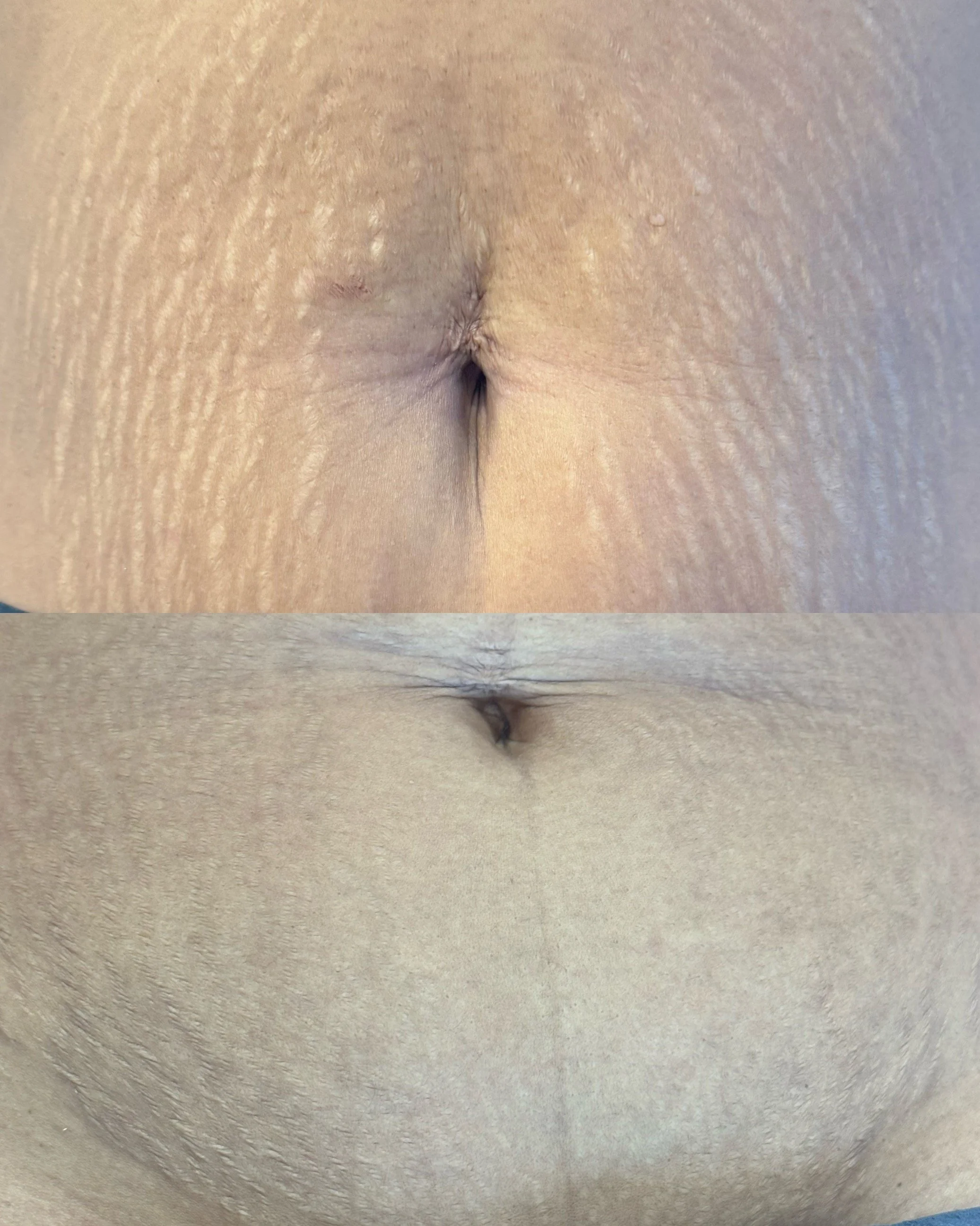 Before and after abdomen stretch marks following inkless stretch mark revision, showing visible texture repair and reduced stretch mark visibility.