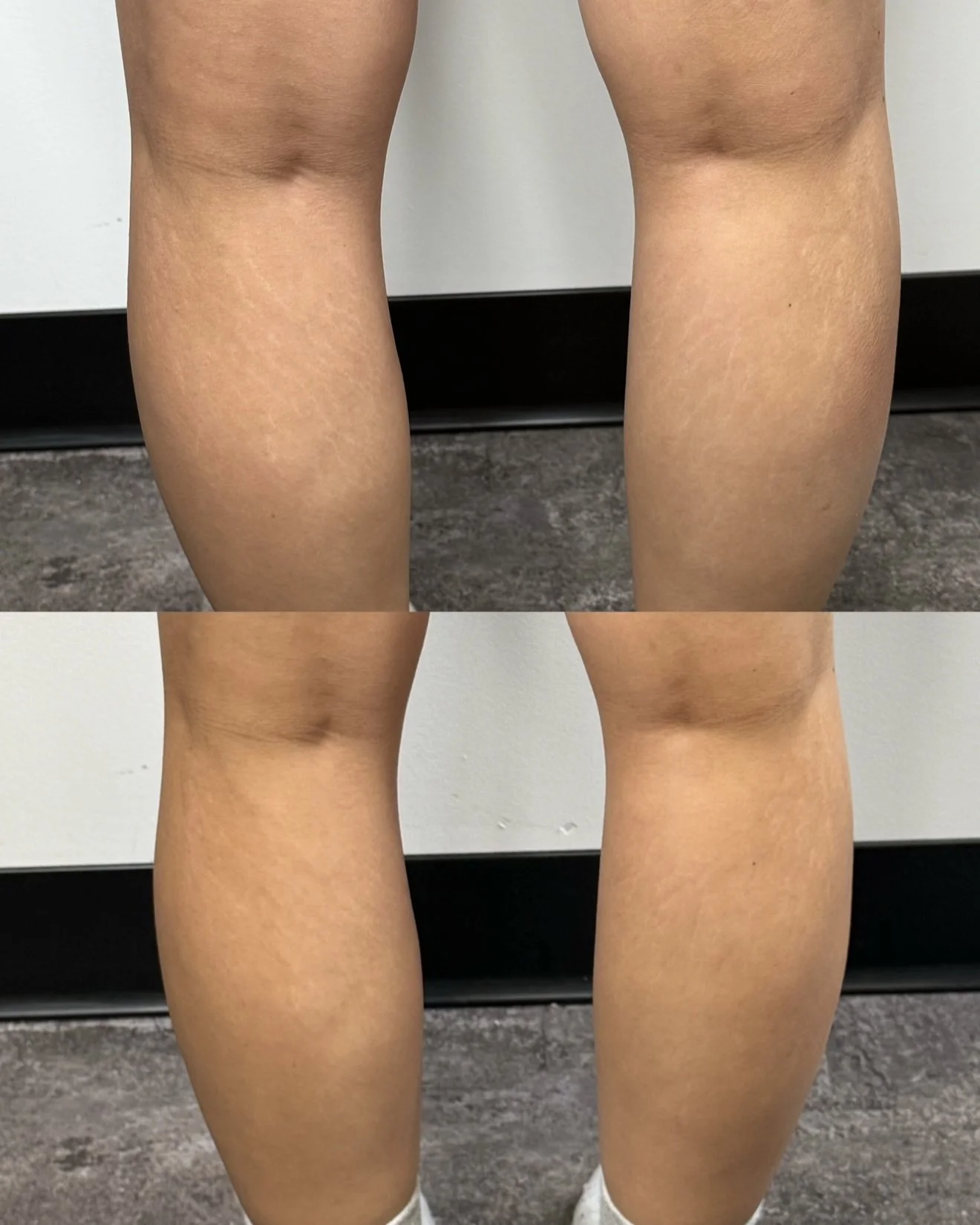 In progress calve stretch marks following inkless stretch mark revision, showing improved skin texture and reduced visibility.