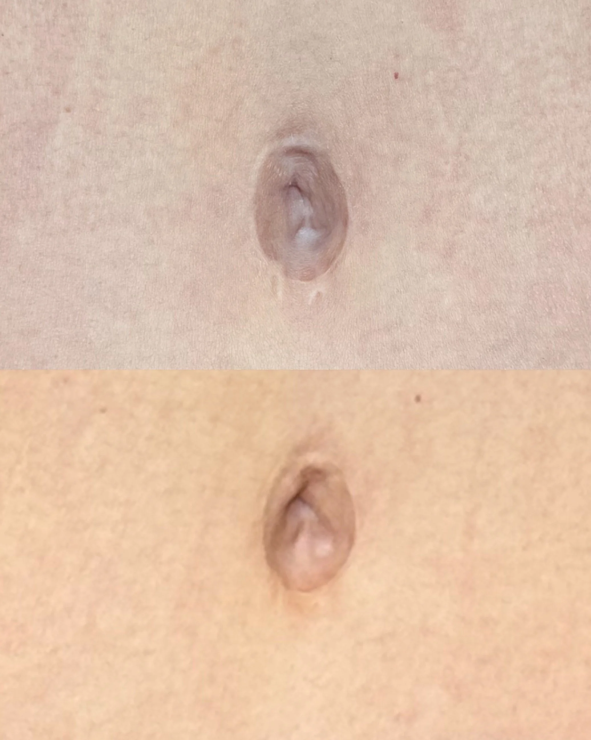 Scar camouflage on belly button after tummy tuck in Edmonton.