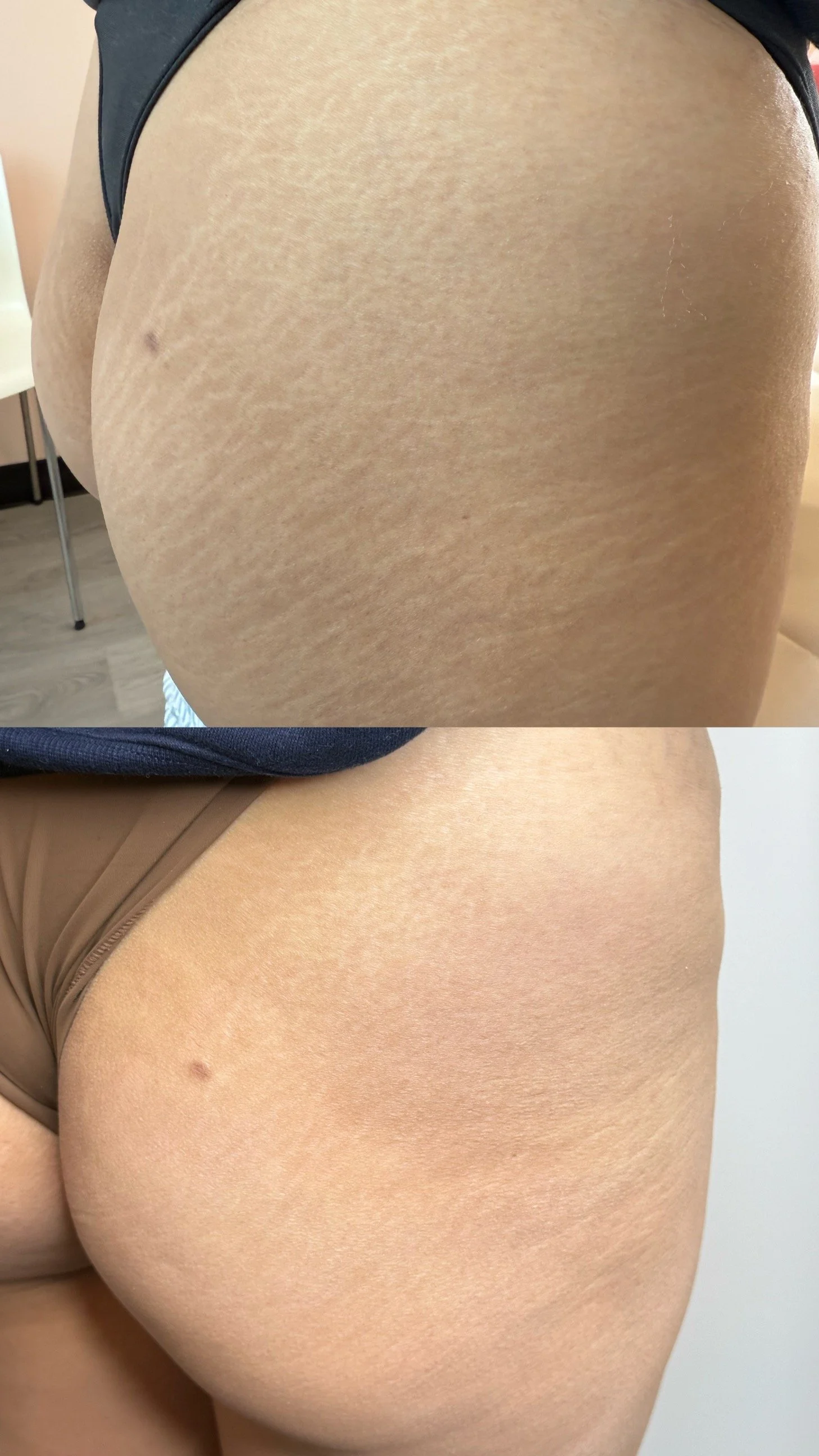 Before and after glute stretch marks following inkless stretch mark revision, showing improved skin texture and reduced visibility.