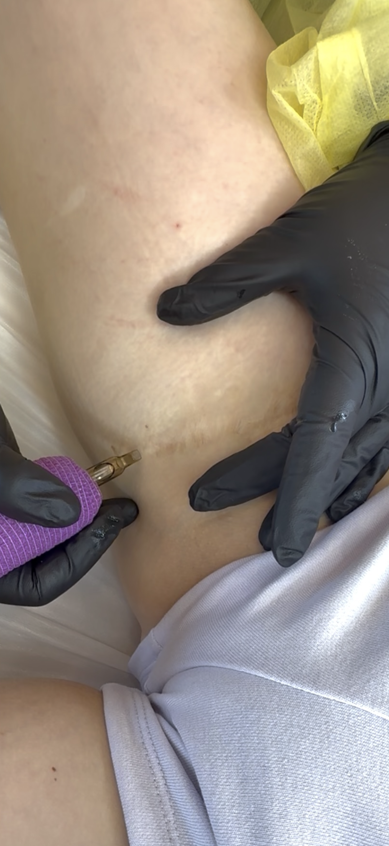 Inkless scar revision being performed on an inner thigh scar.