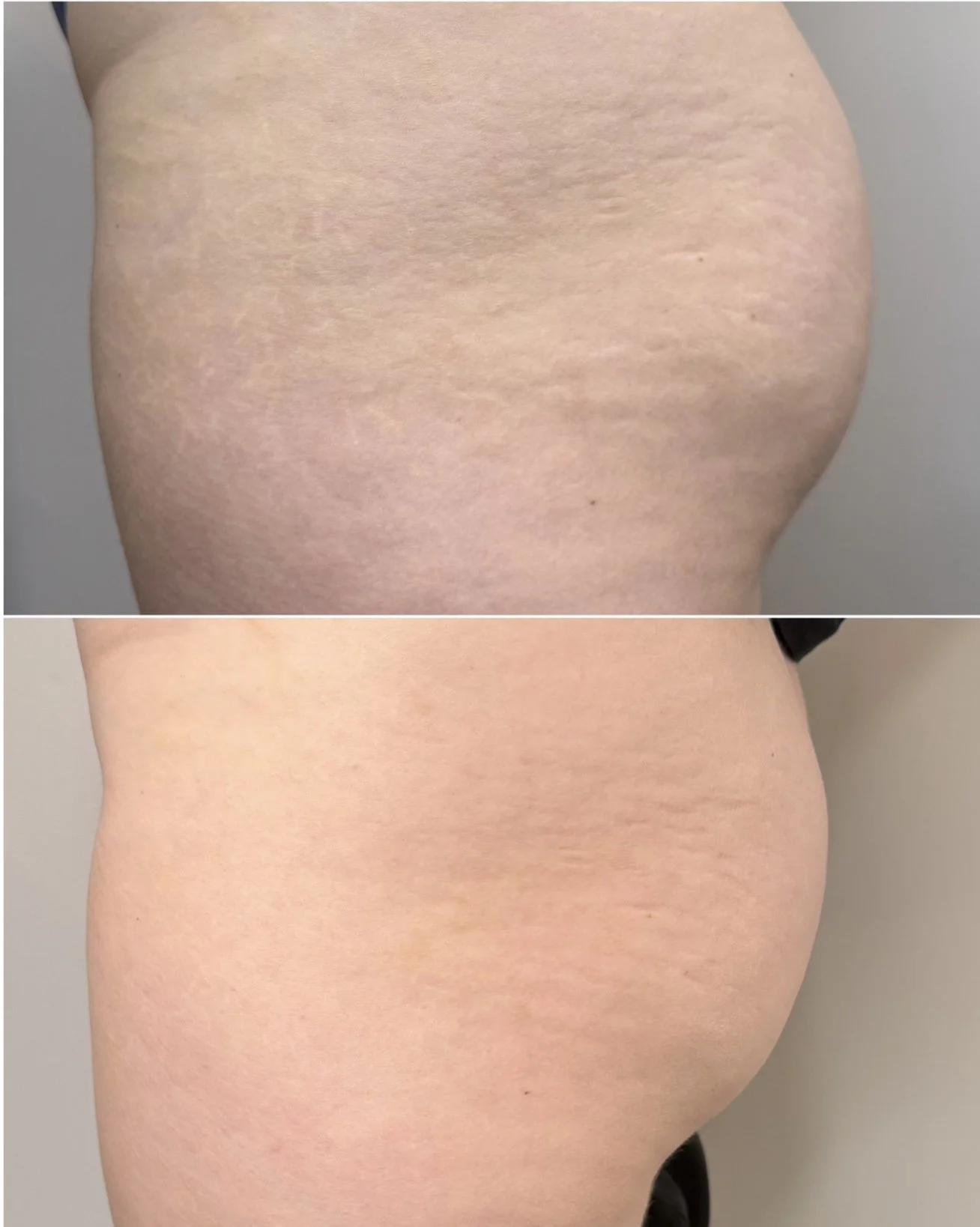In progress glute stretch mark repair showing visible improvement in skin texture after inkless stretch mark revision.