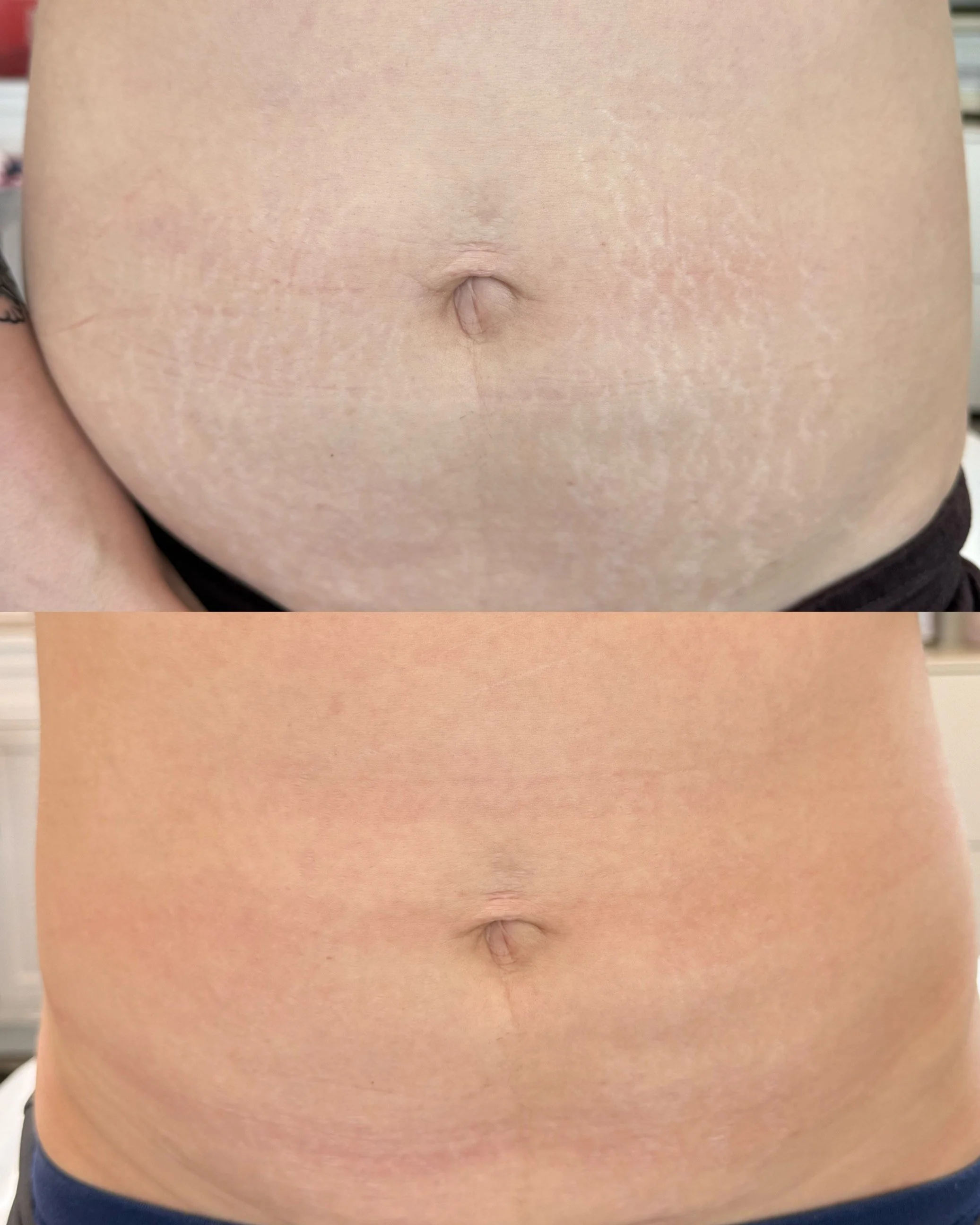 Before and after abdomen stretch marks following inkless stretch mark revision, showing visible
improvement in skin texture and reduced stretch mark visibility.