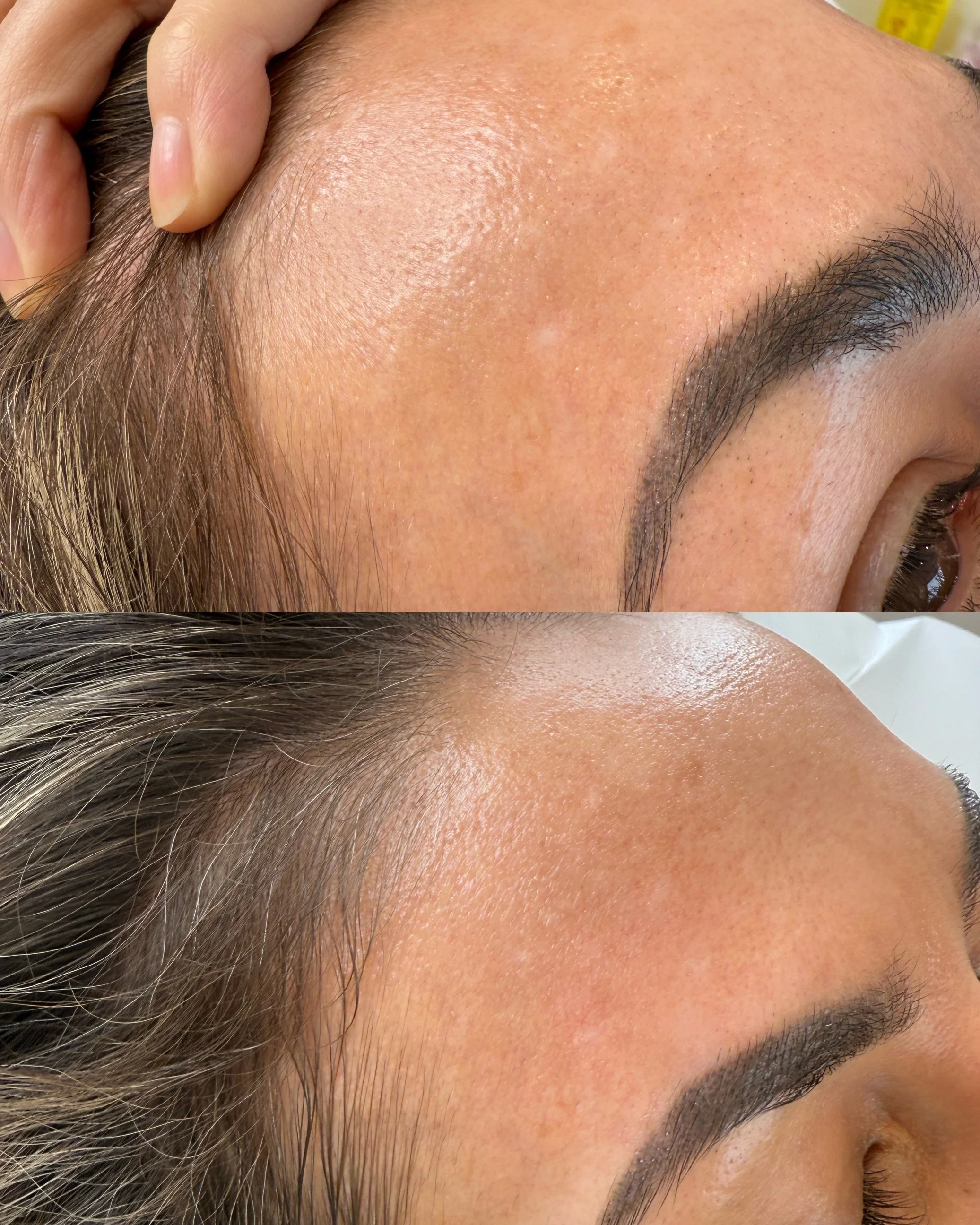 Before and after forehead hypopigmentation scar following scar camouflage treatment, showing improved colour blending and reduced scar visibility.