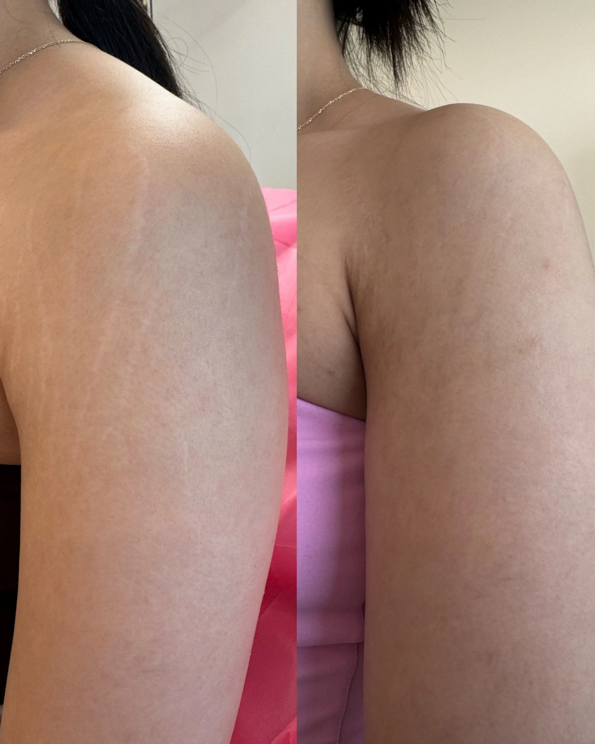Before and after shoulder stretch marks following inkless stretch mark revision, showing visible improvement in skin texture and reduced stretch mark visibility.