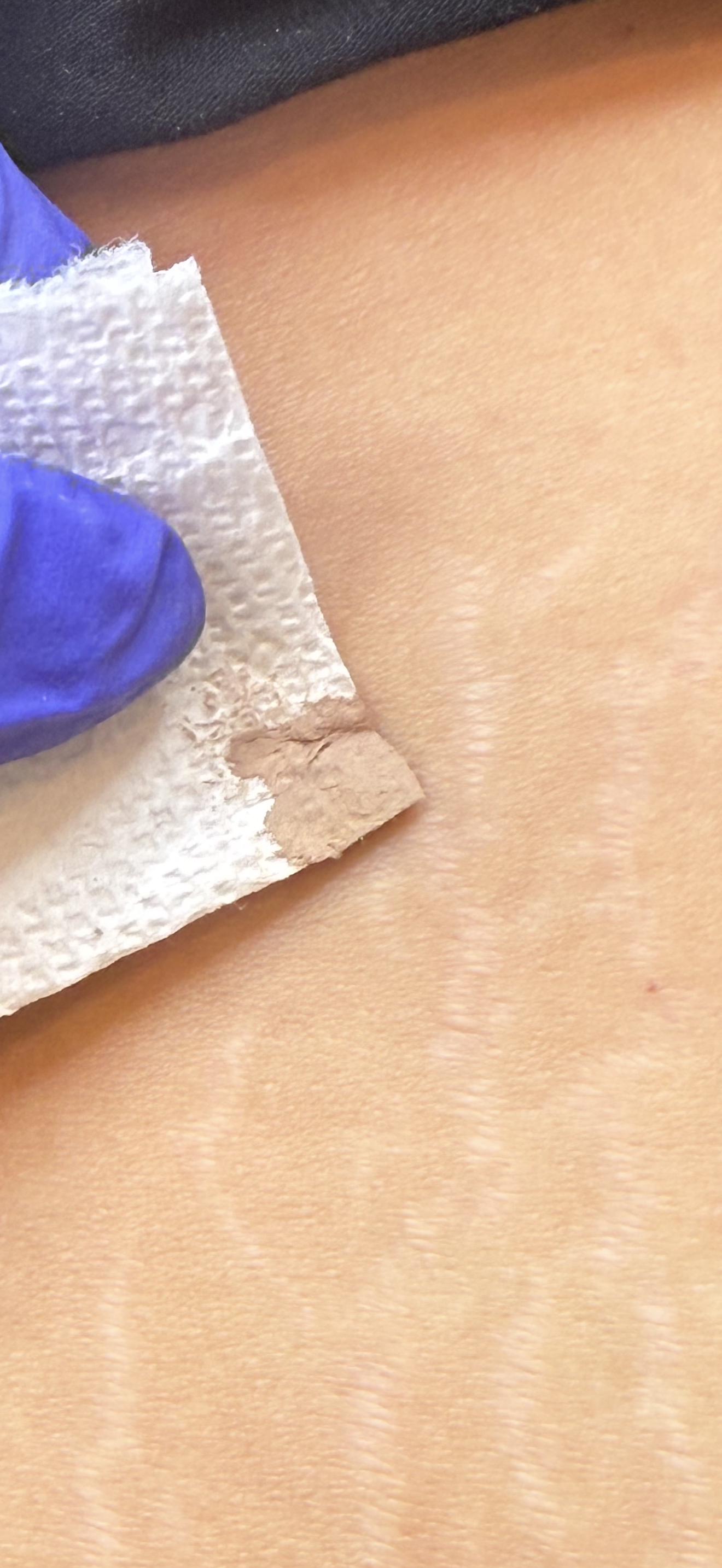 Custom skin tone colour match applied to stretch marks during stretch mark camouflage treatment.