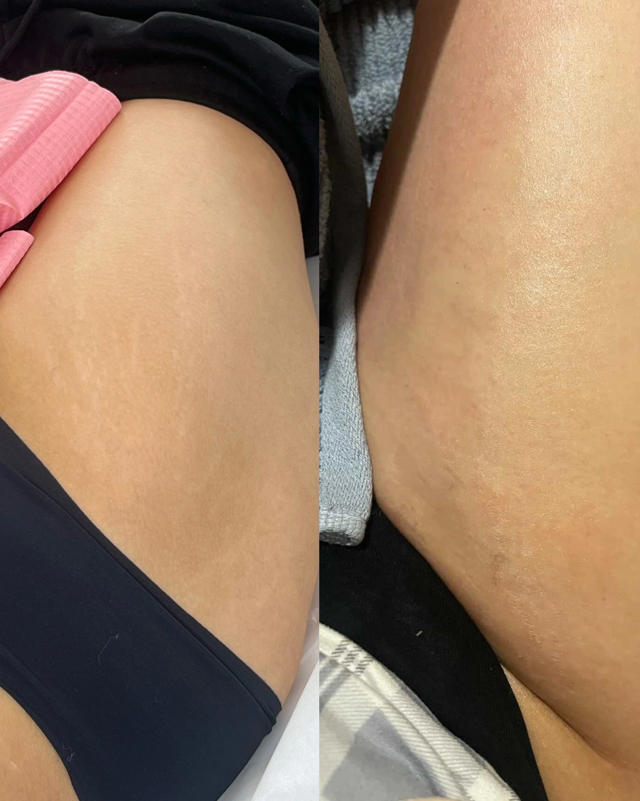 Before and after thigh stretch marks following inkless stretch mark revision, showing improved skin texture and reduced stretch mark visibility.