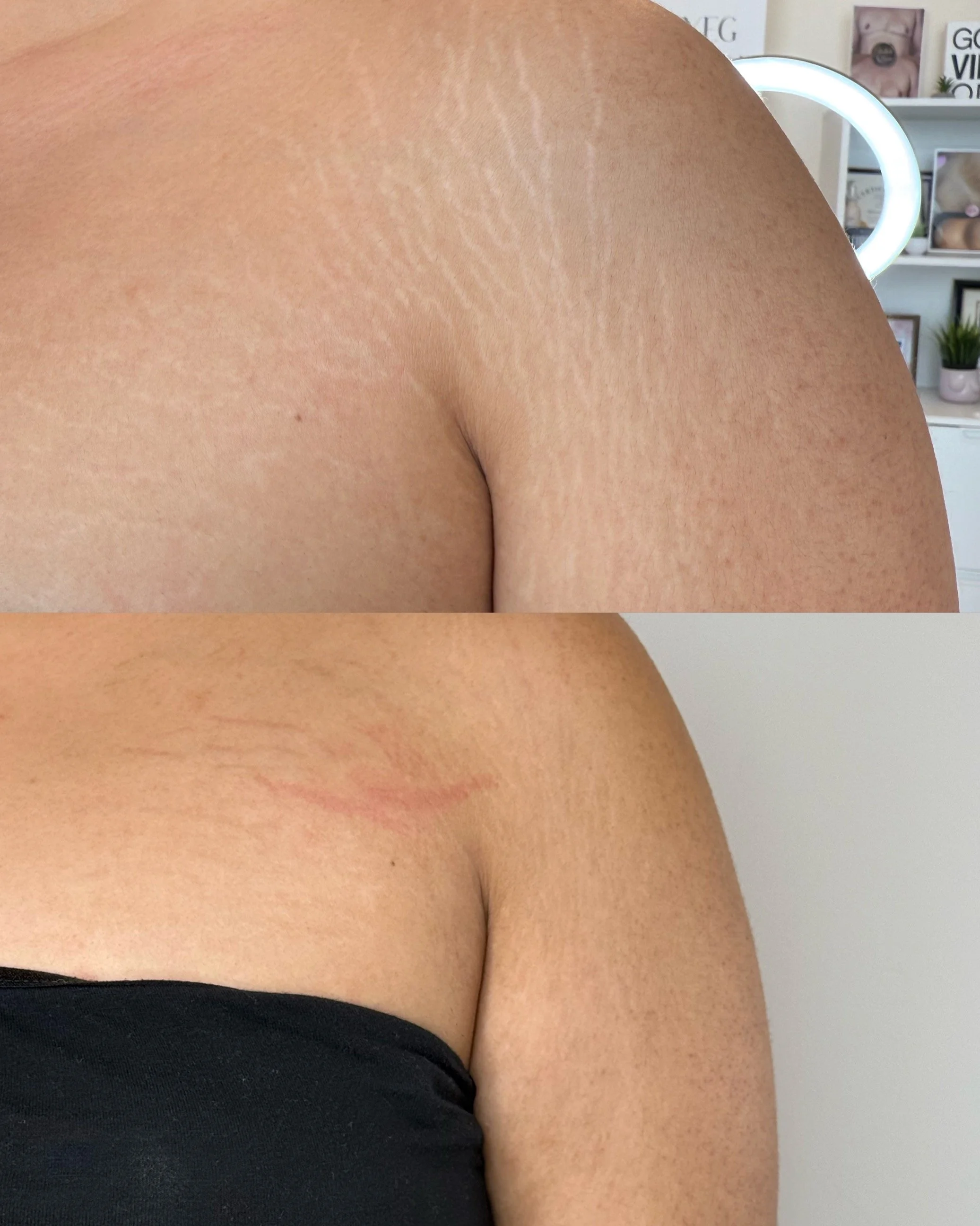 Progress before and after shoulder stretch mark revision showing improved skin texture and reduced appearance of stretch marks.