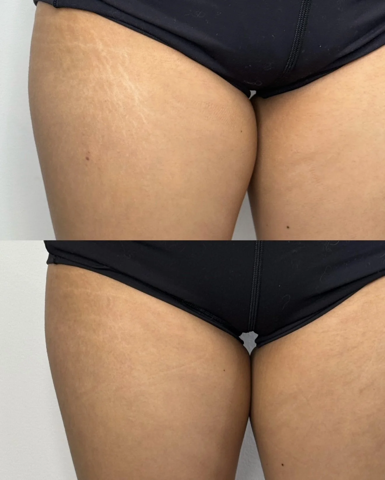 In progress before and after stretch mark repair showing visible improvement in skin texture.