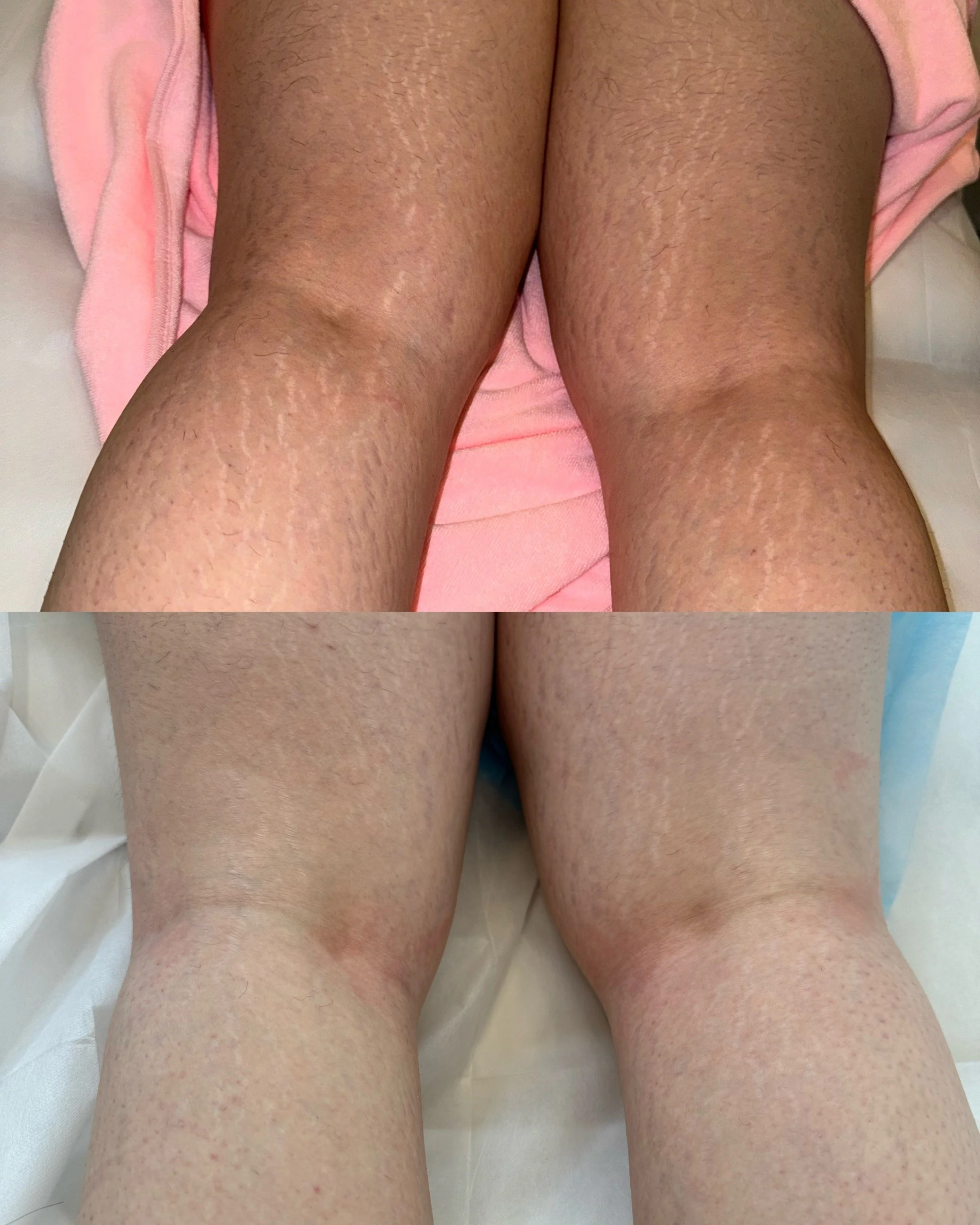 In progress calve and thigh stretch marks following inkless stretch mark revision, showing visible improvement in skin texture and reduced stretch mark visibility.