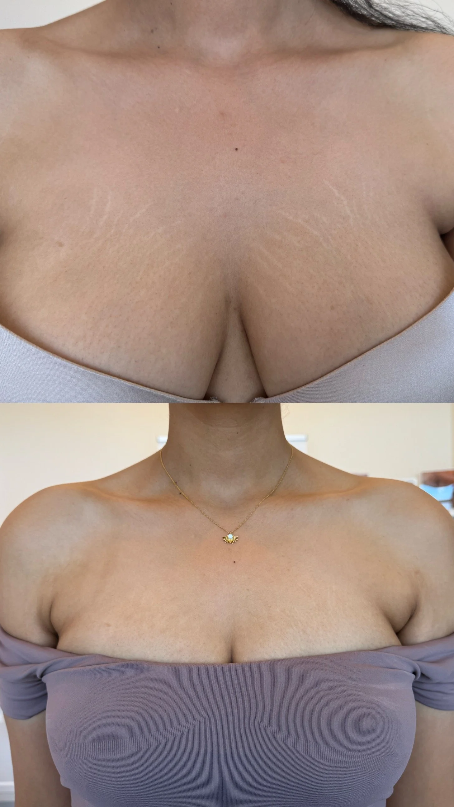 Before and after breast stretch marks following inkless stretch mark revision, showing improved texture and reduced stretch mark visibility.