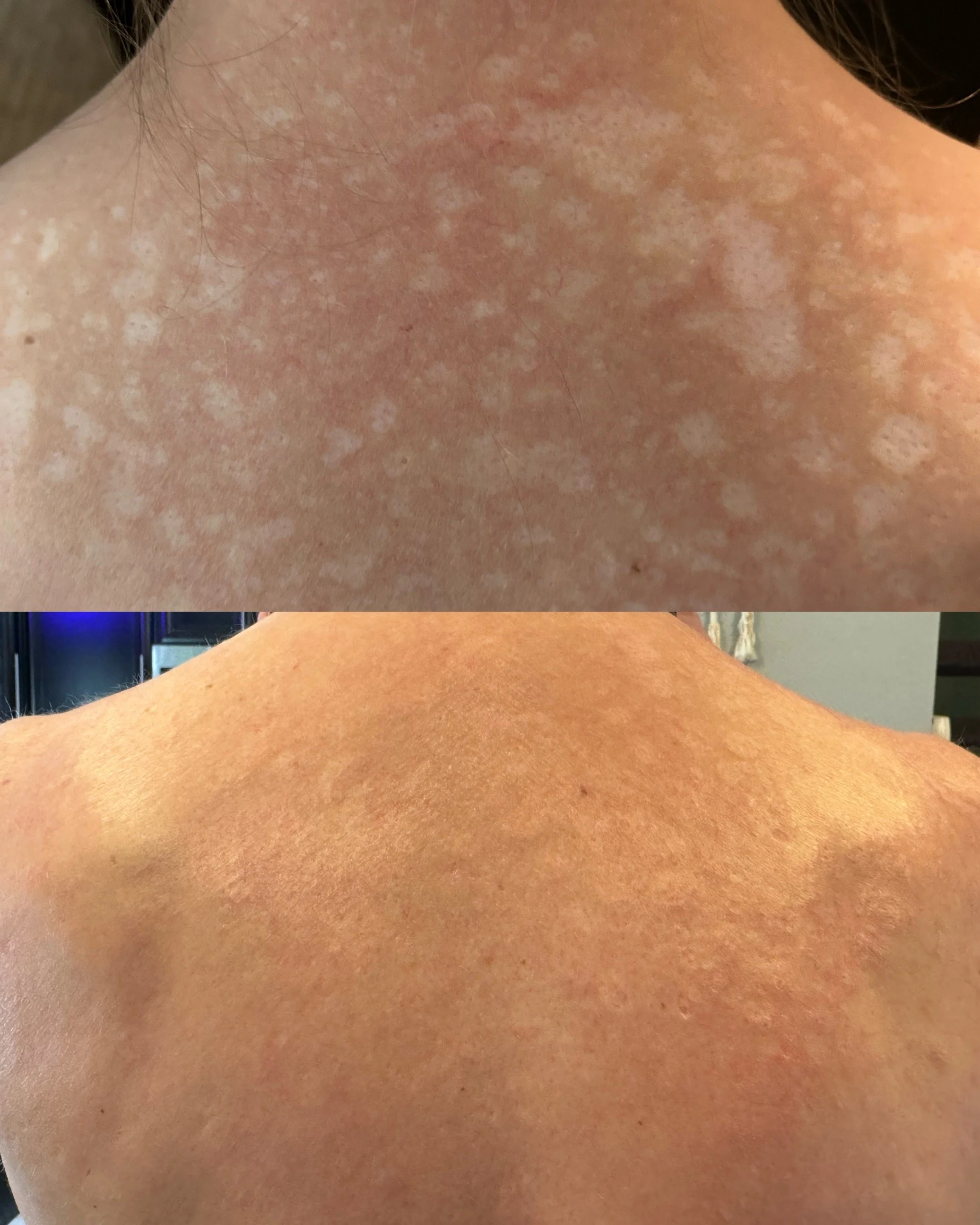 Before and after hypopigmentation scars on the back following scar camouflage treatment, showing improved colour blending and reduced scar visibility.