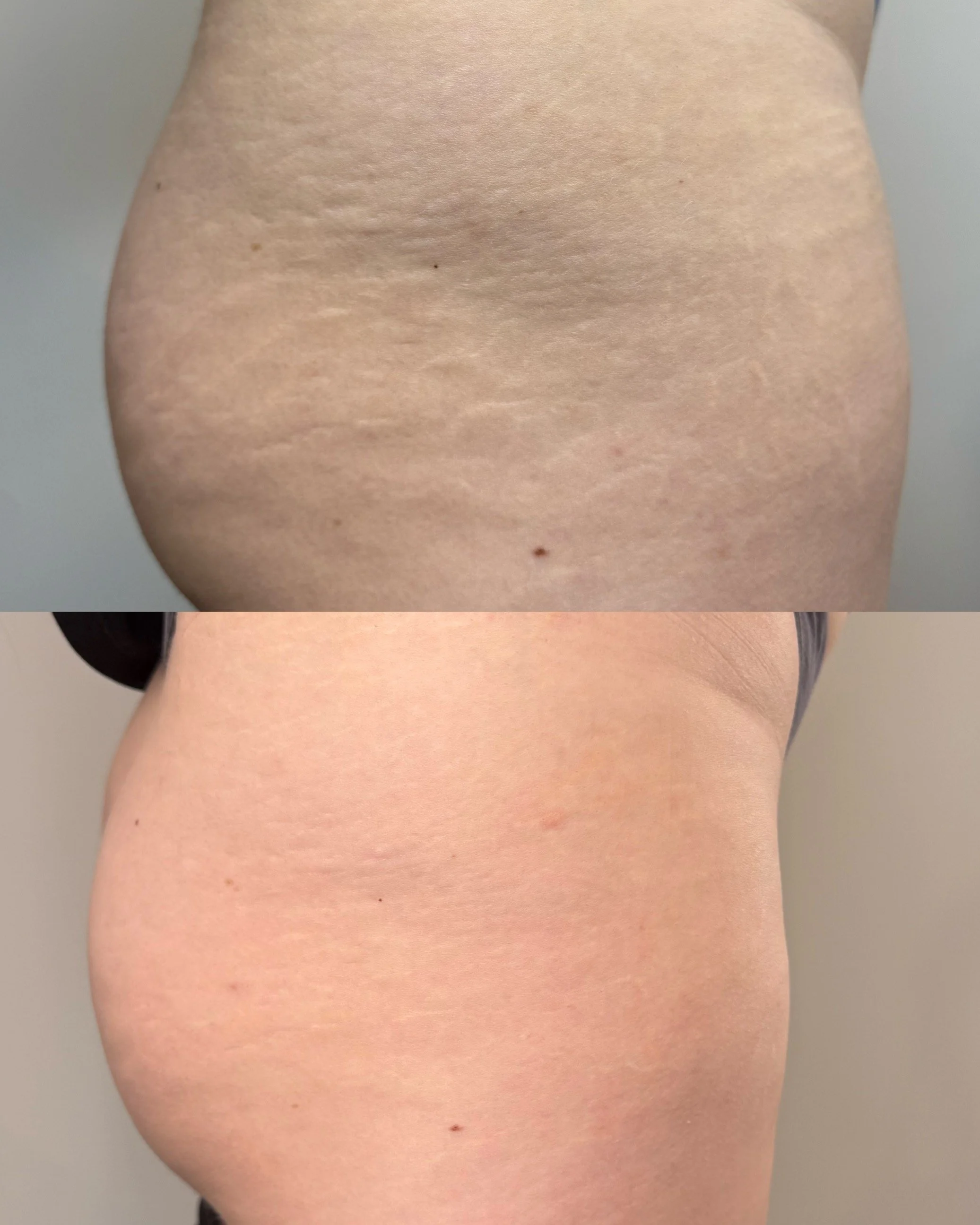 In progress before and after stretch mark revision on the glutes and hips showing improved skin texture and reduced visibility of stretch marks.
