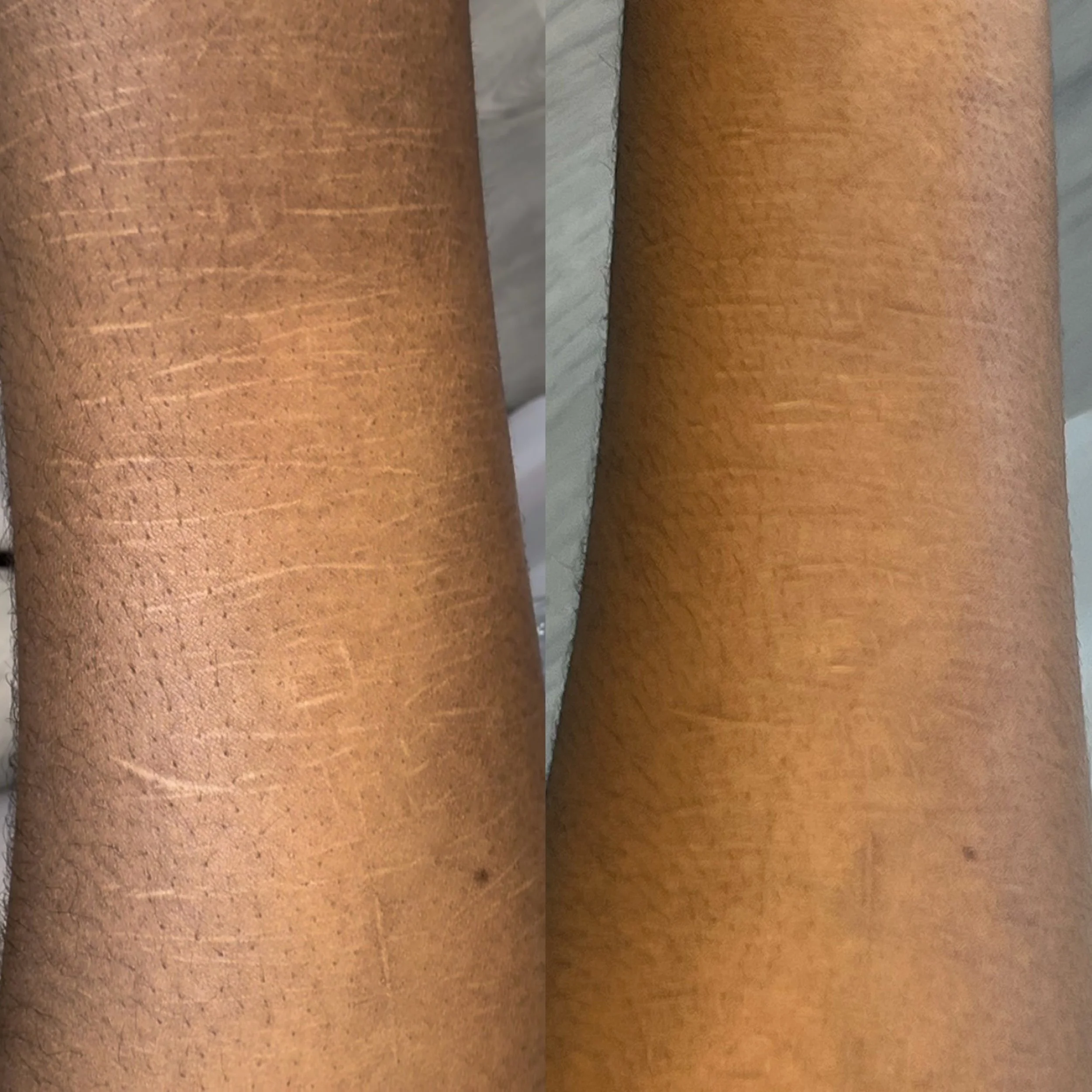 Before and after self harm scars on melanin rich skin following scar camouflage treatments, showing improved colour blending and reduced scar visibility.