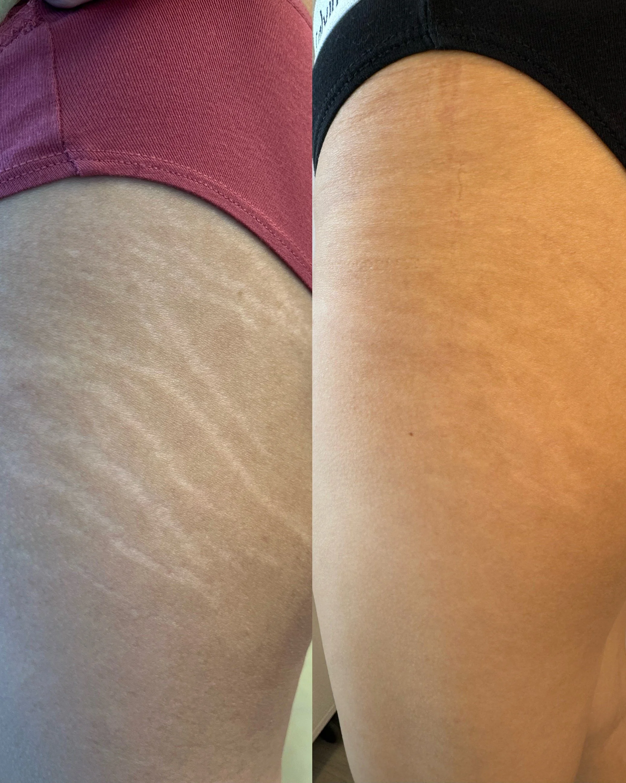 Before and after glute stretch marks following inkless stretch mark revision, showing improved skin texture and reduced stretch mark visibility.