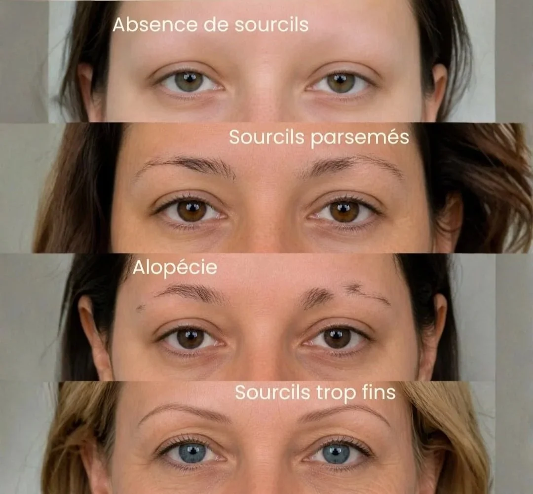 Comparaison entre différents problèmes de sourcils sur des femmes, montrant l'absence de sourcils, des sourcils dessinés, alopécie, et des sourcils trop fins.
