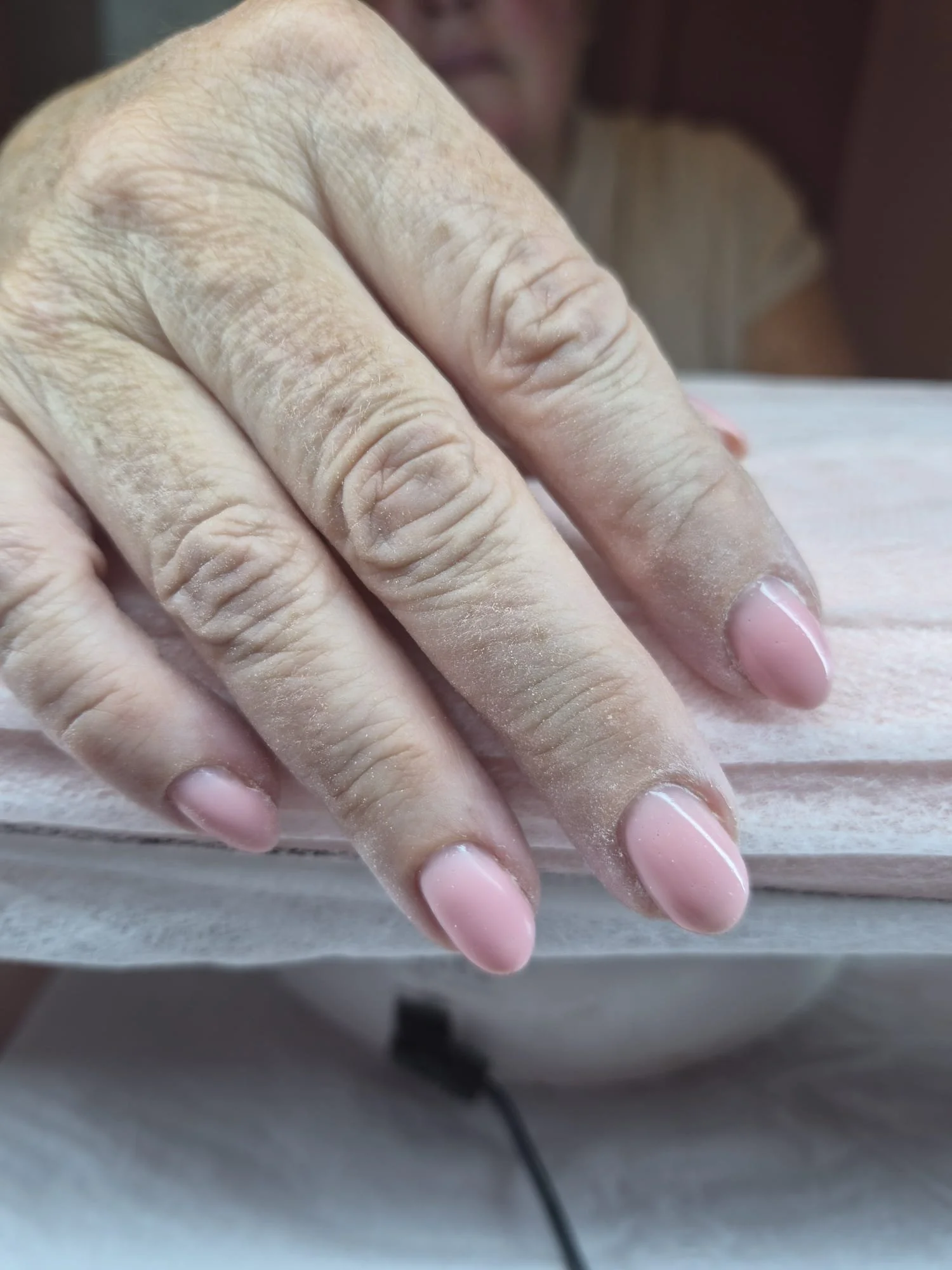Close-up of a person's hand with dry skin, resting on a surface, with part of the person's face visible in the background.