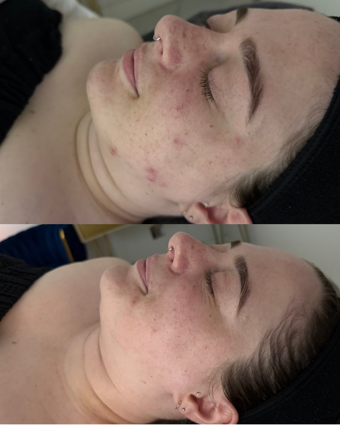 A side-by-side comparison of a woman's face showing before and after skin treatment, revealing clear improvements in skin condition.