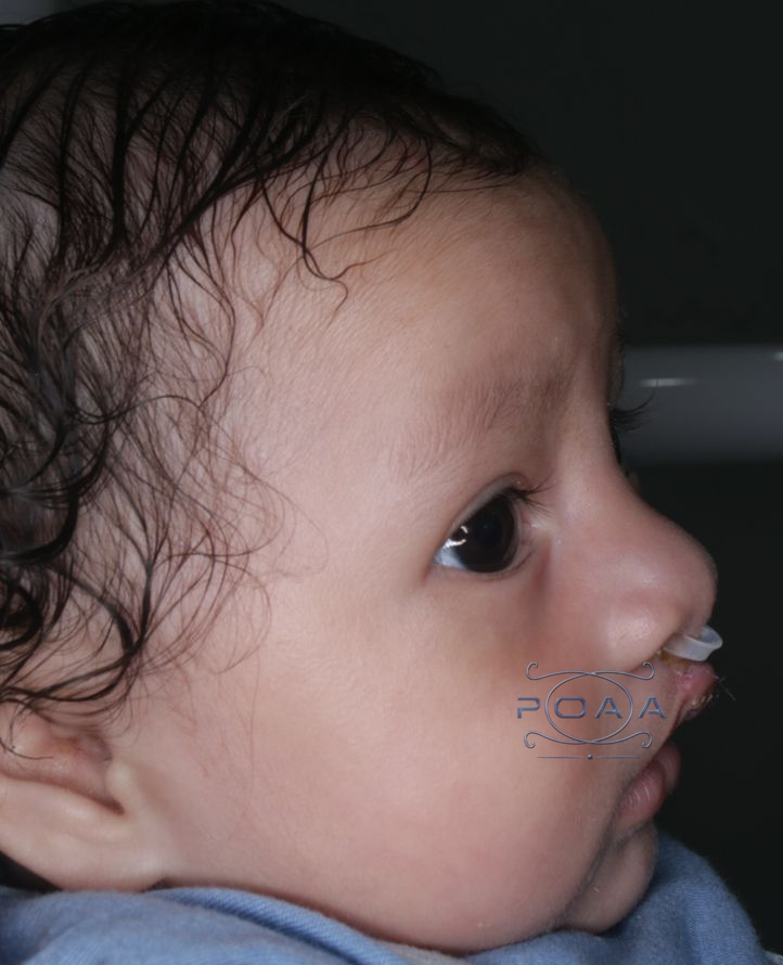labio post quirurjico 3.png