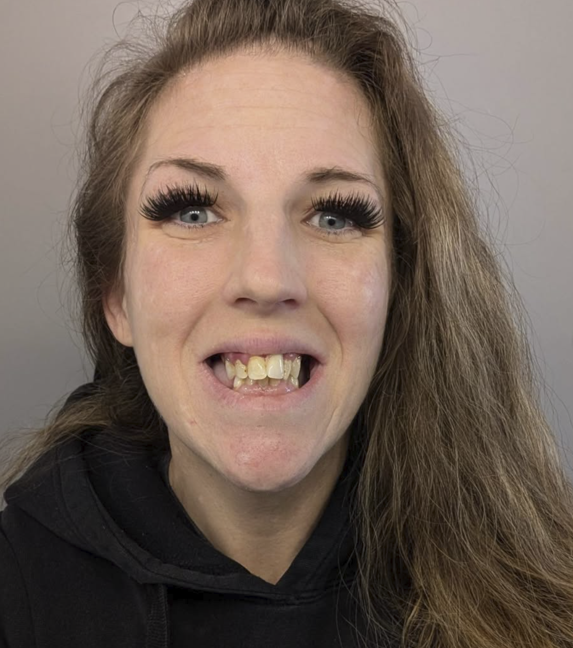 A woman with long brown hair, blue eyes, and exaggerated long black eyelashes, smiling with missing and misaligned teeth, wearing a black hoodie.