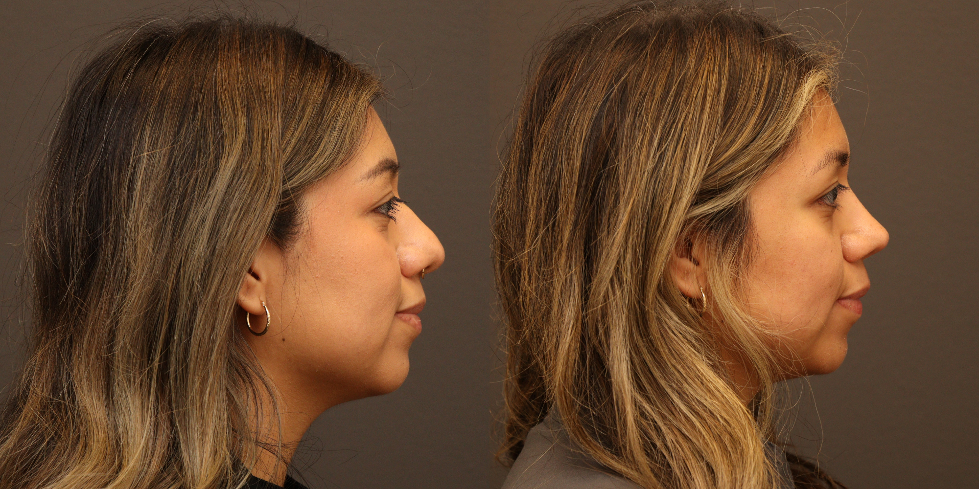 Rhinoplasty, Lower Blepharoplasty