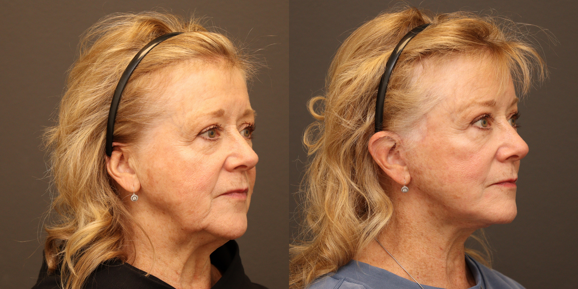 Deep Plane Face & Neck Lift, Endoscopic Brow Lift