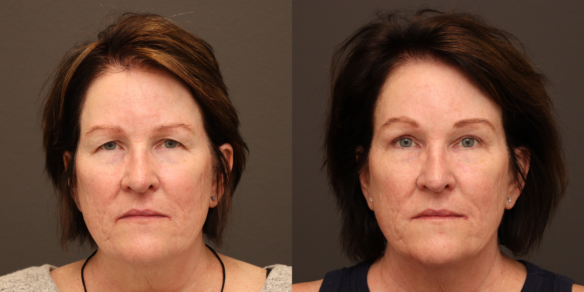 Upper Blepharoplasty, Endoscopic Brow Lift
