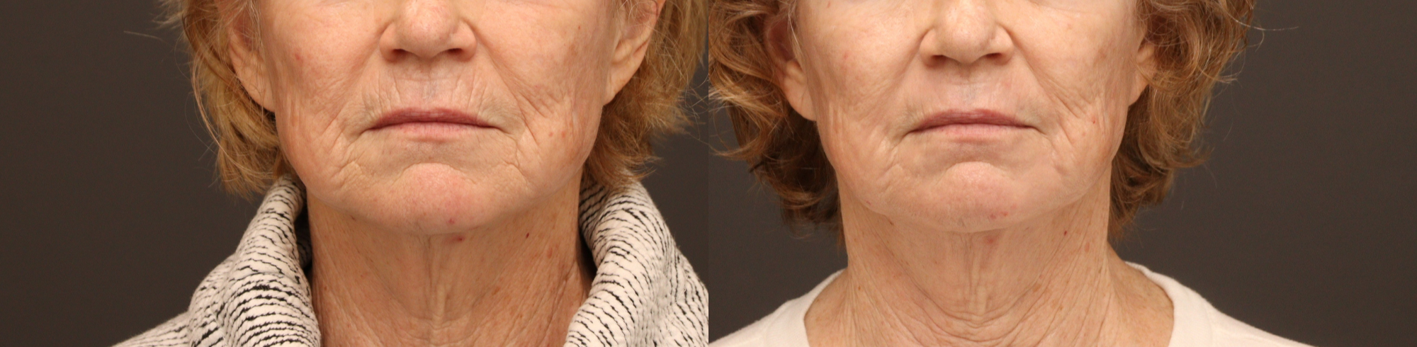 Perioral Laser Resurfacing