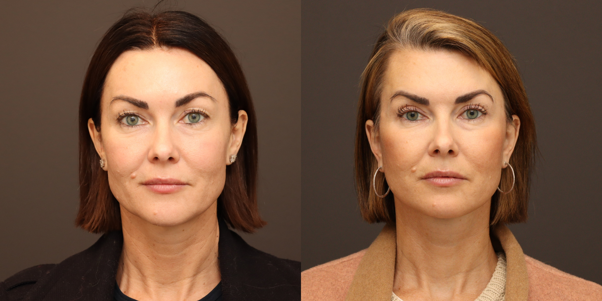 Upper Blepharoplasty