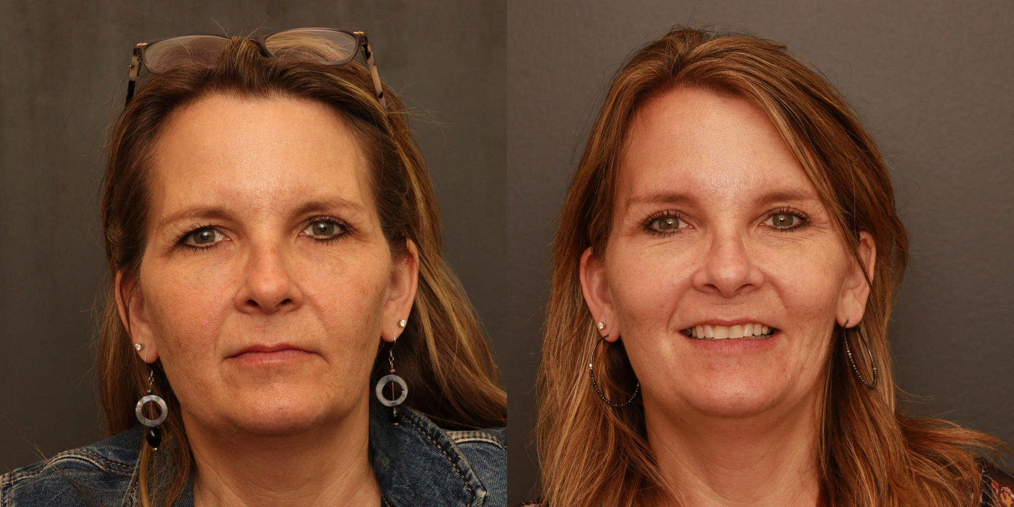 Upper Blepharoplasty, Endoscopic Brow Lift