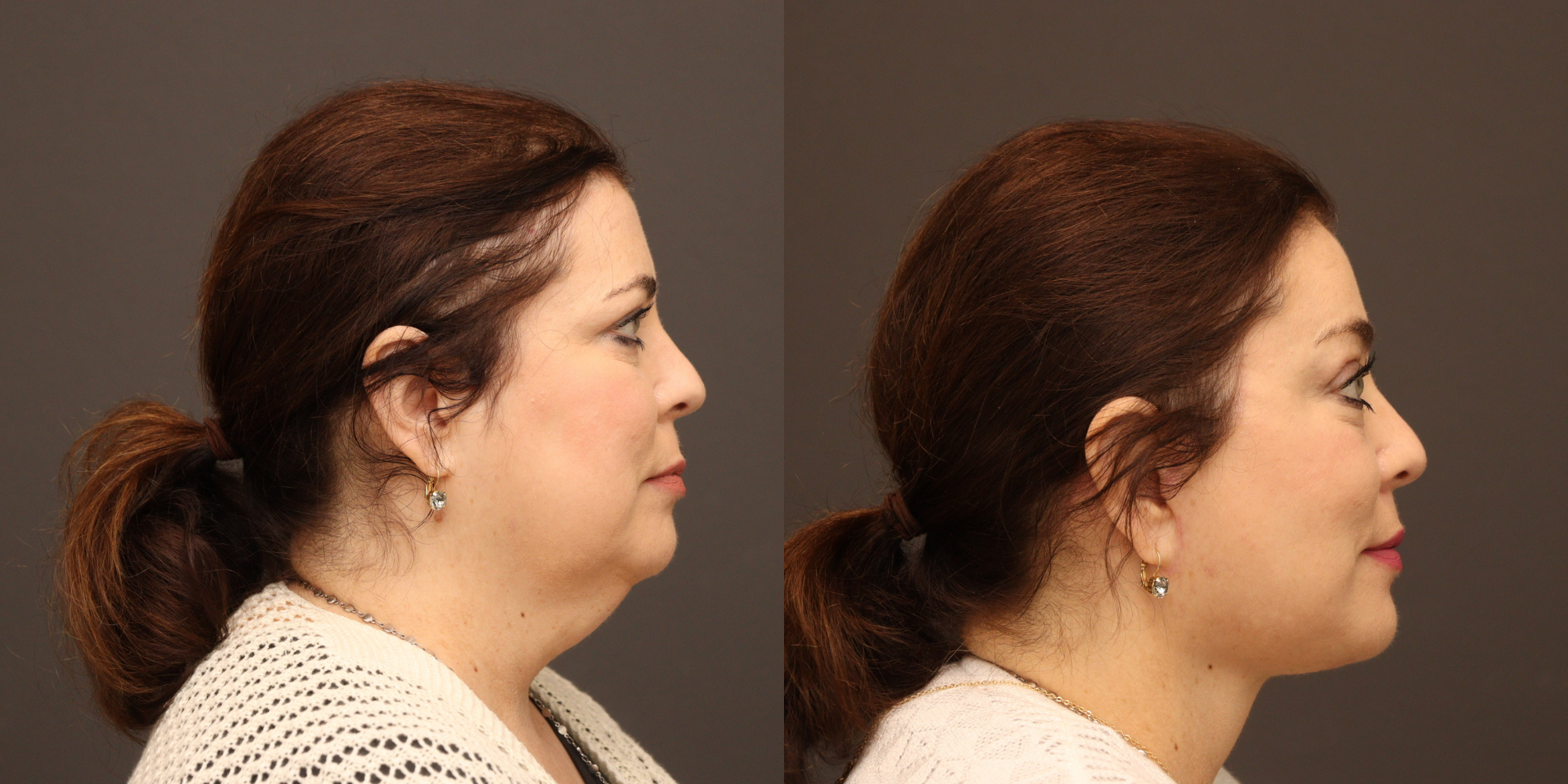 Deep Plane Face & Neck Lift, Temporal Brow Lift, Buccal Fat Removal 
