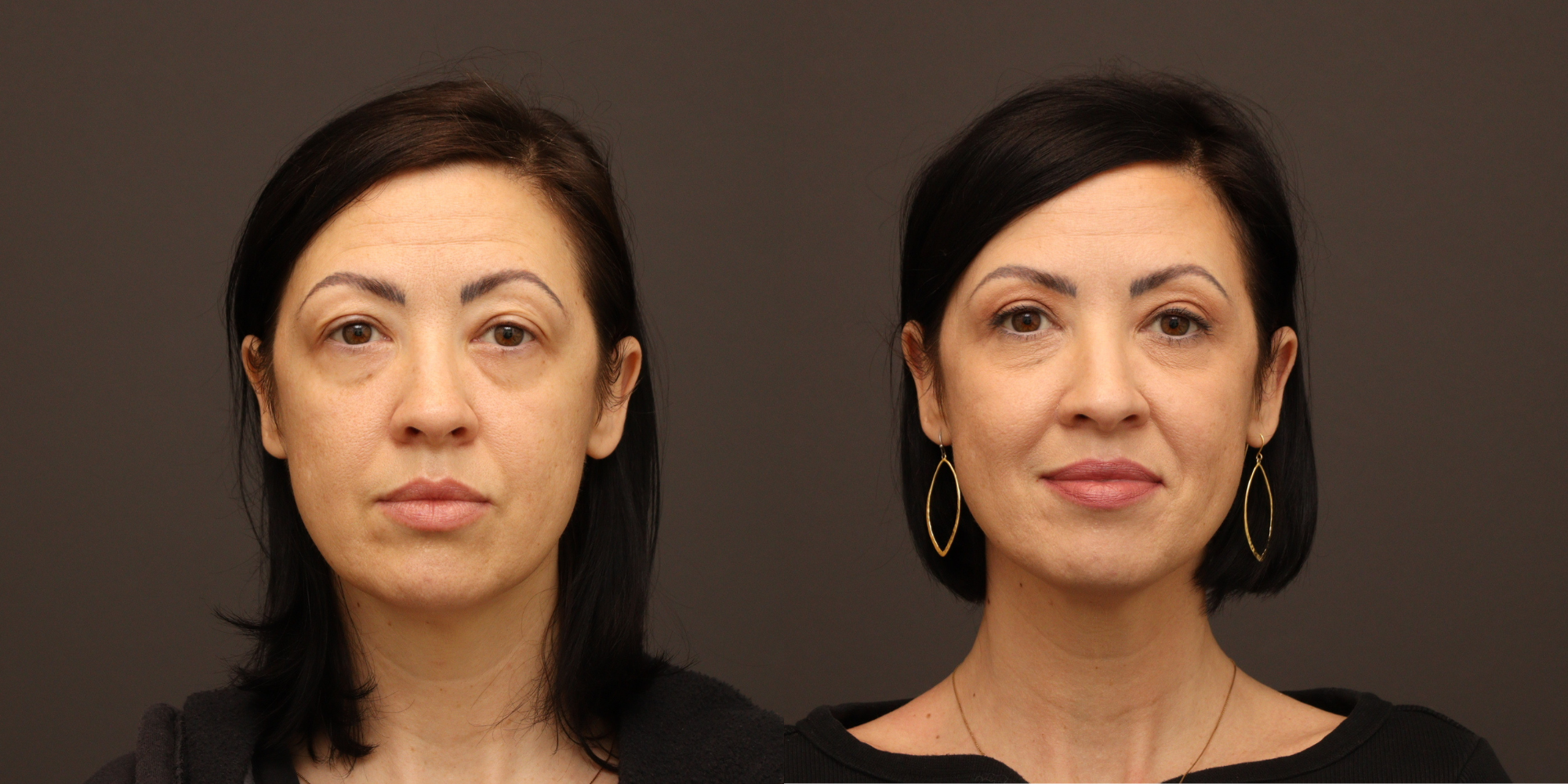 Upper Blepharoplasty