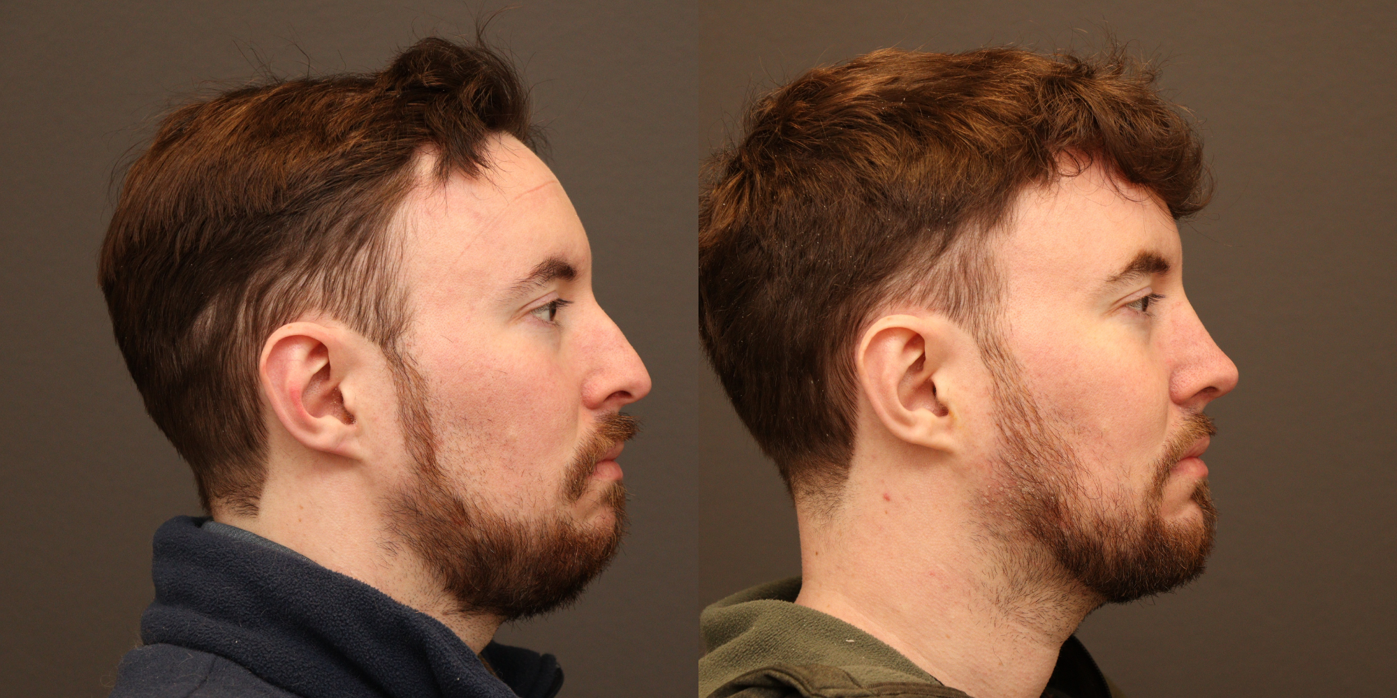 Rhinoplasty, Chin Augmentation