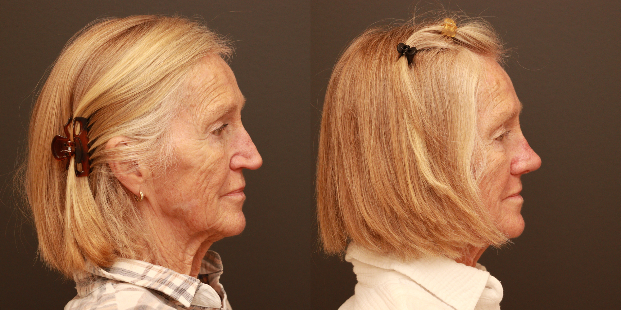 Rhinoplasty with Cadaveric Rib Grafting