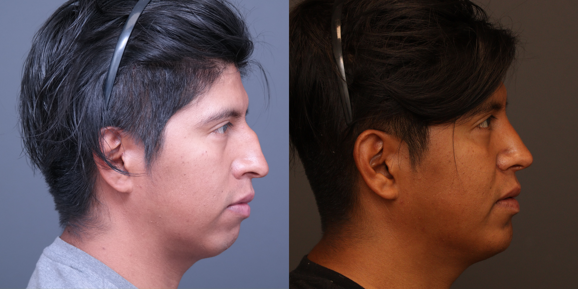 Rhinoplasty, Chin Implant