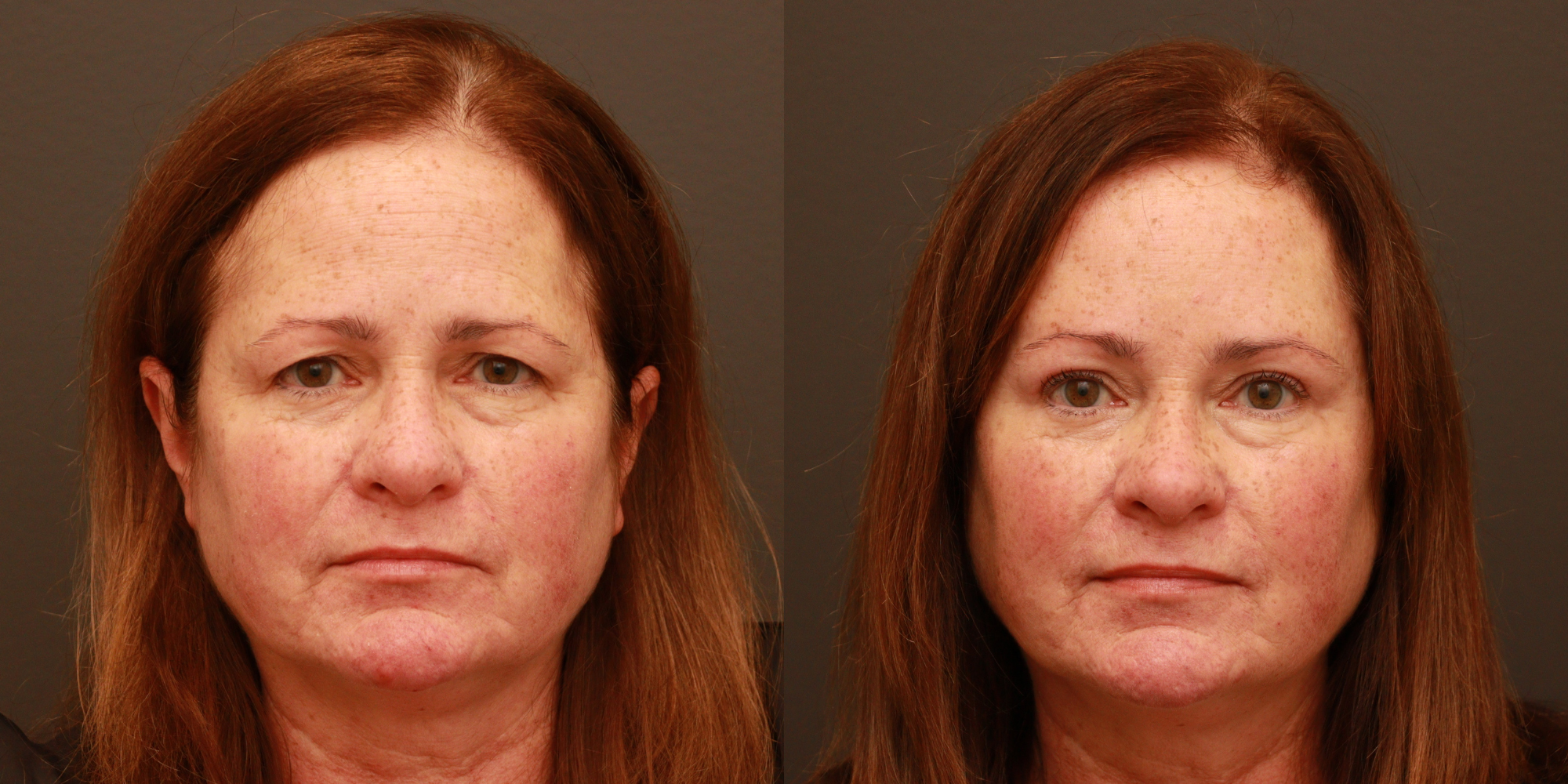 Upper Blepharoplasty, Endoscopic Brow Lift