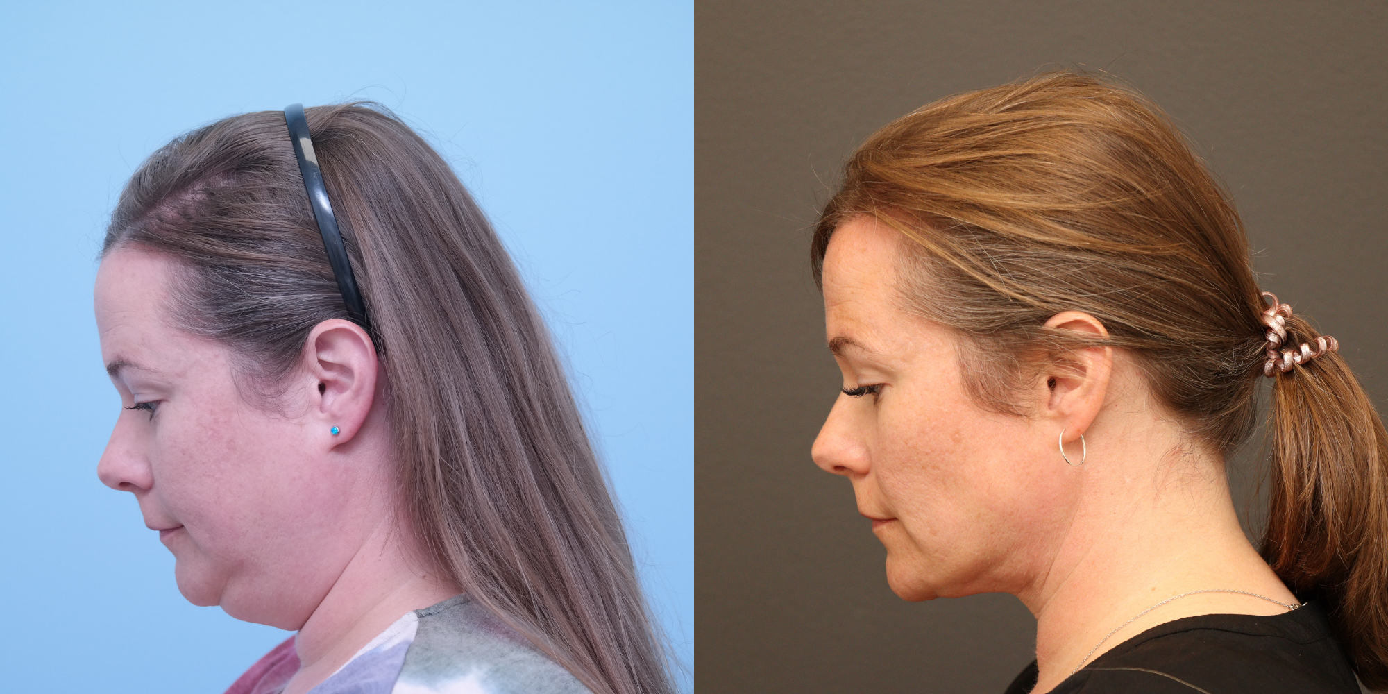Deep Neck Lift, Buccal Fat Reduction